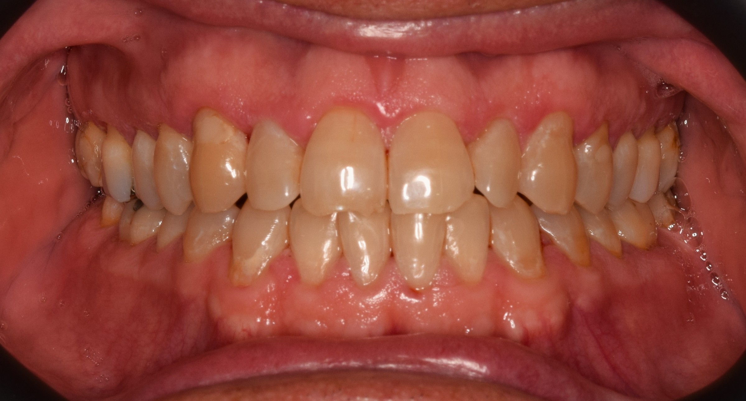 Before treatment