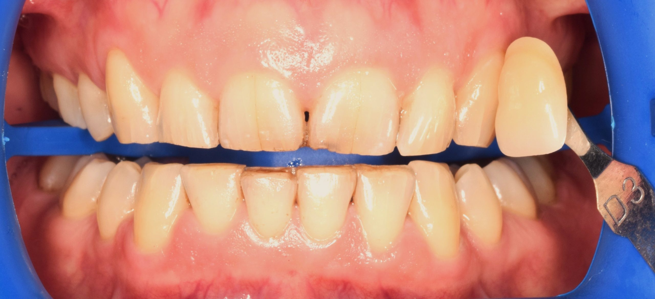 Before treatment