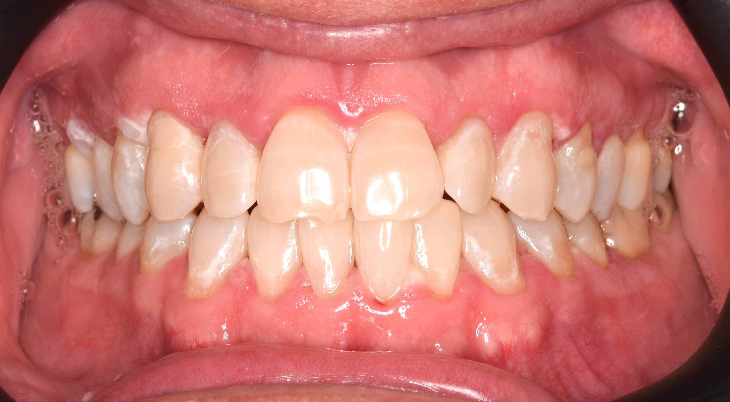After treatment