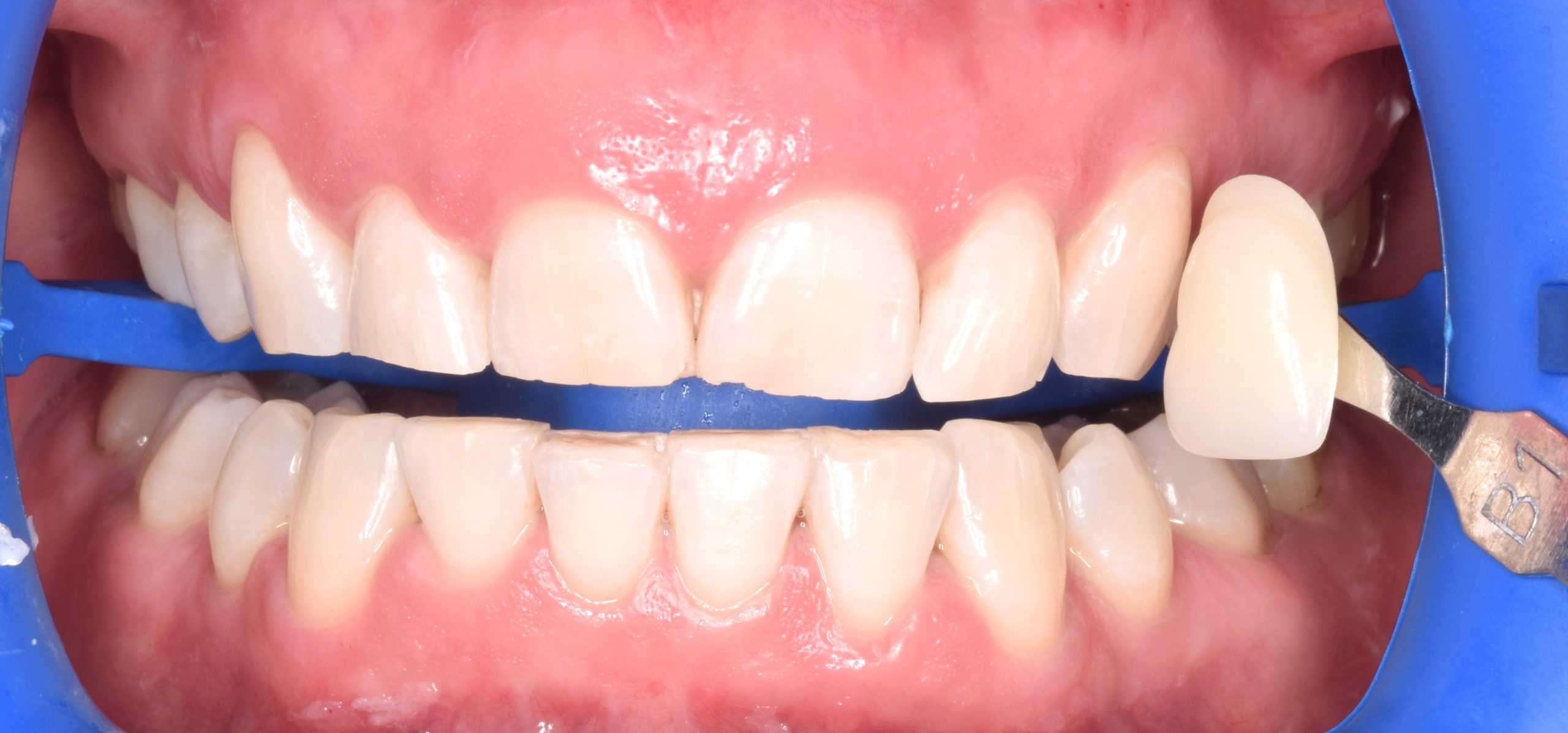 After treatment