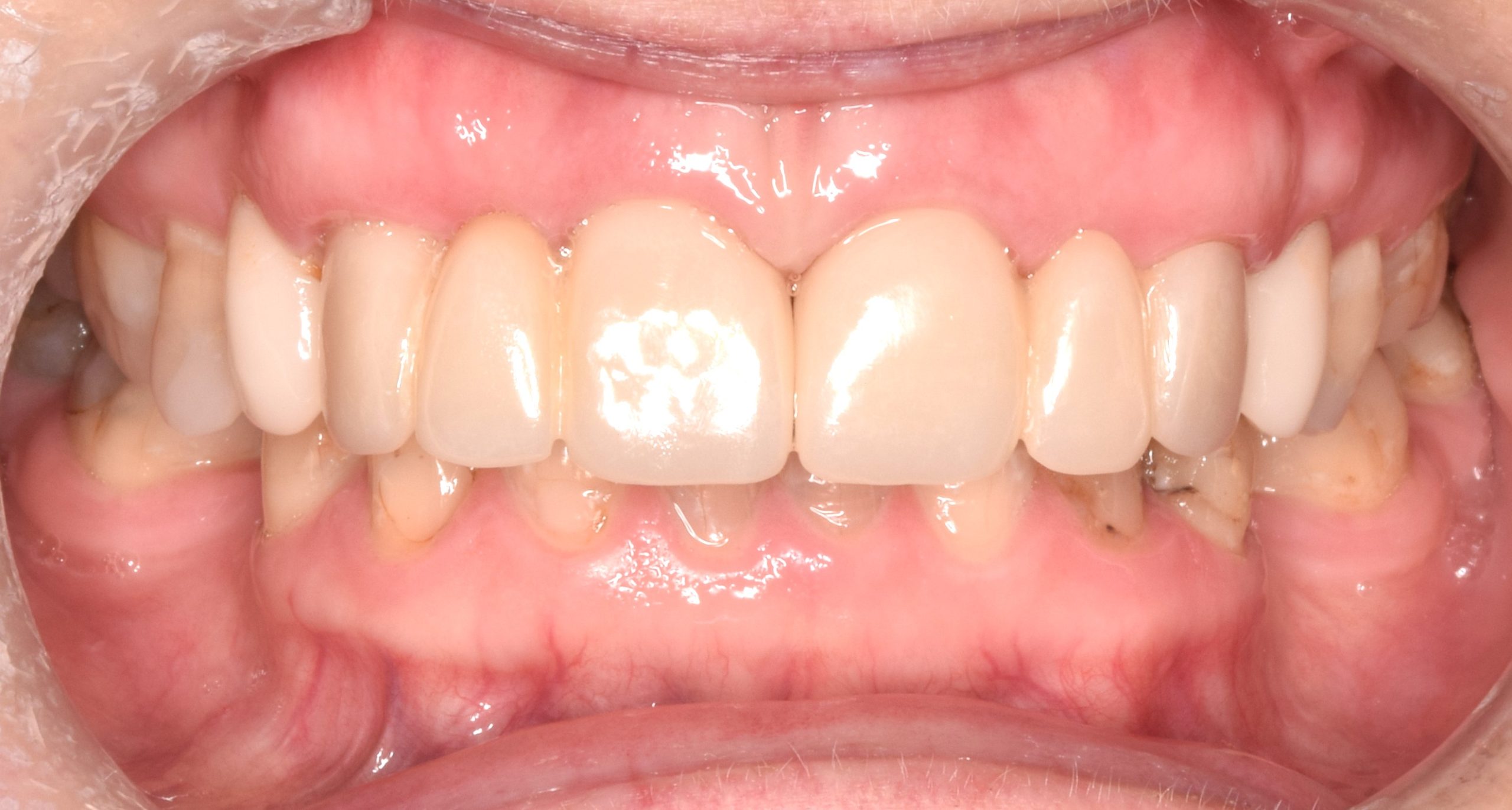 After treatment