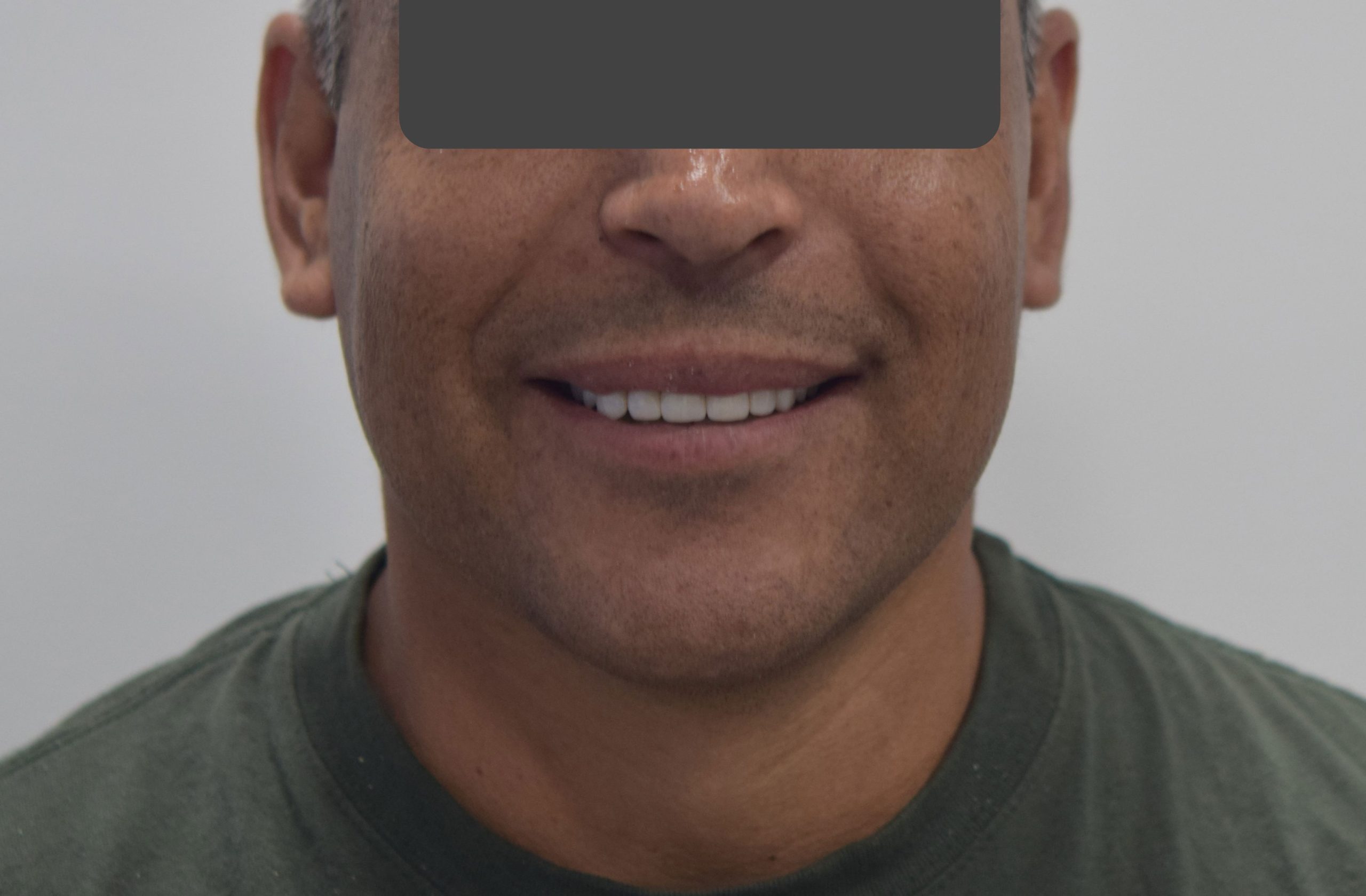 After treatment