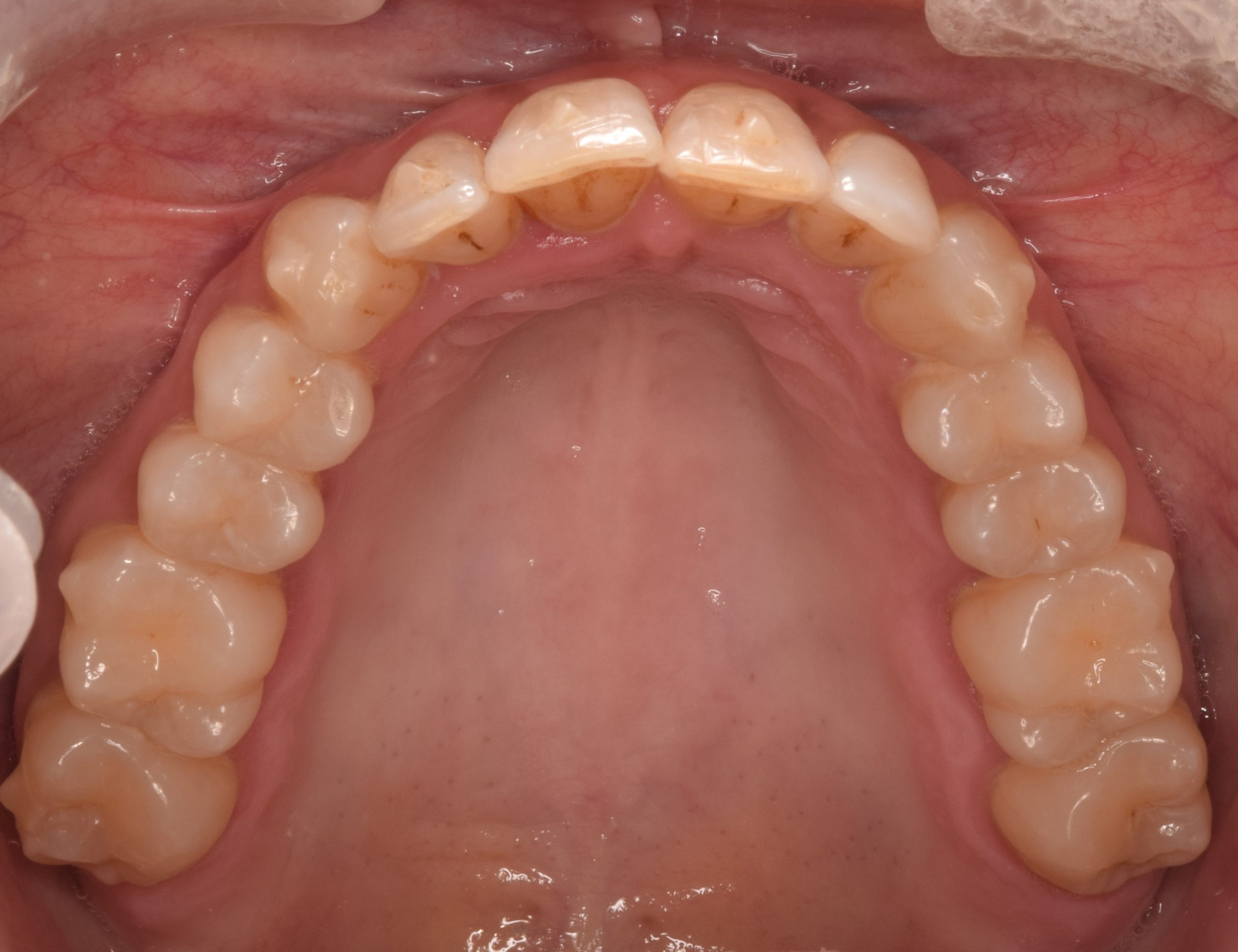 Before treatment