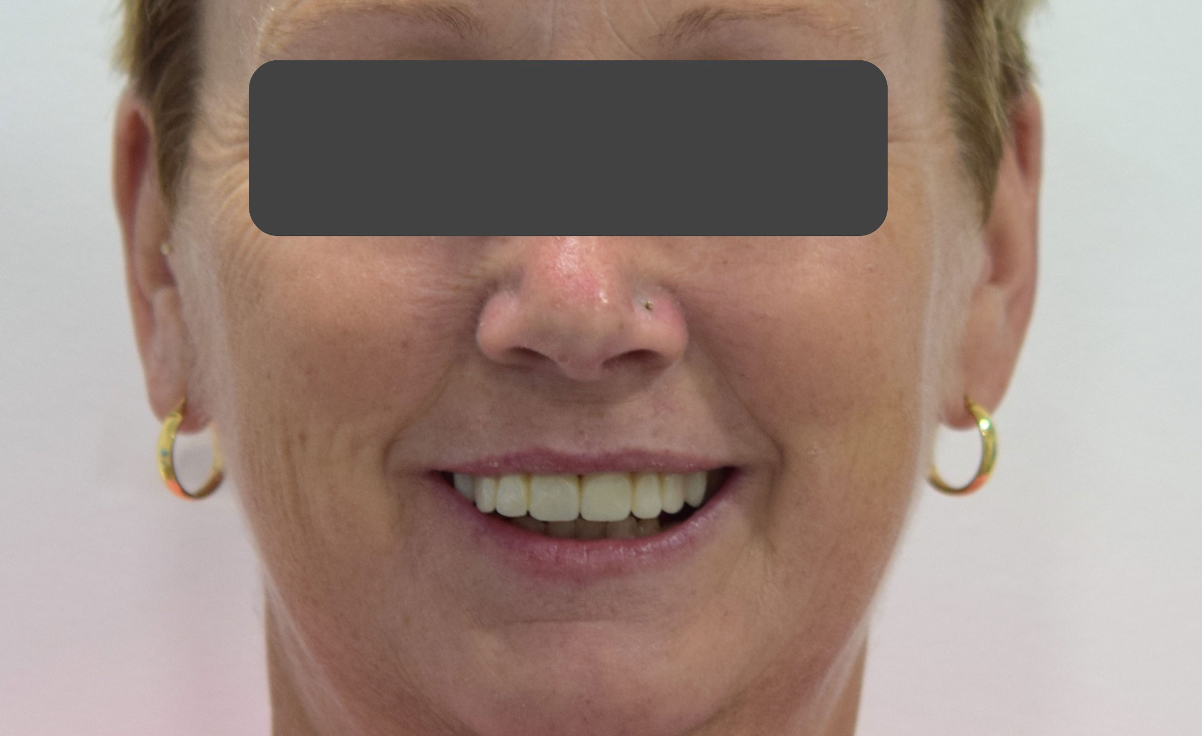 After treatment