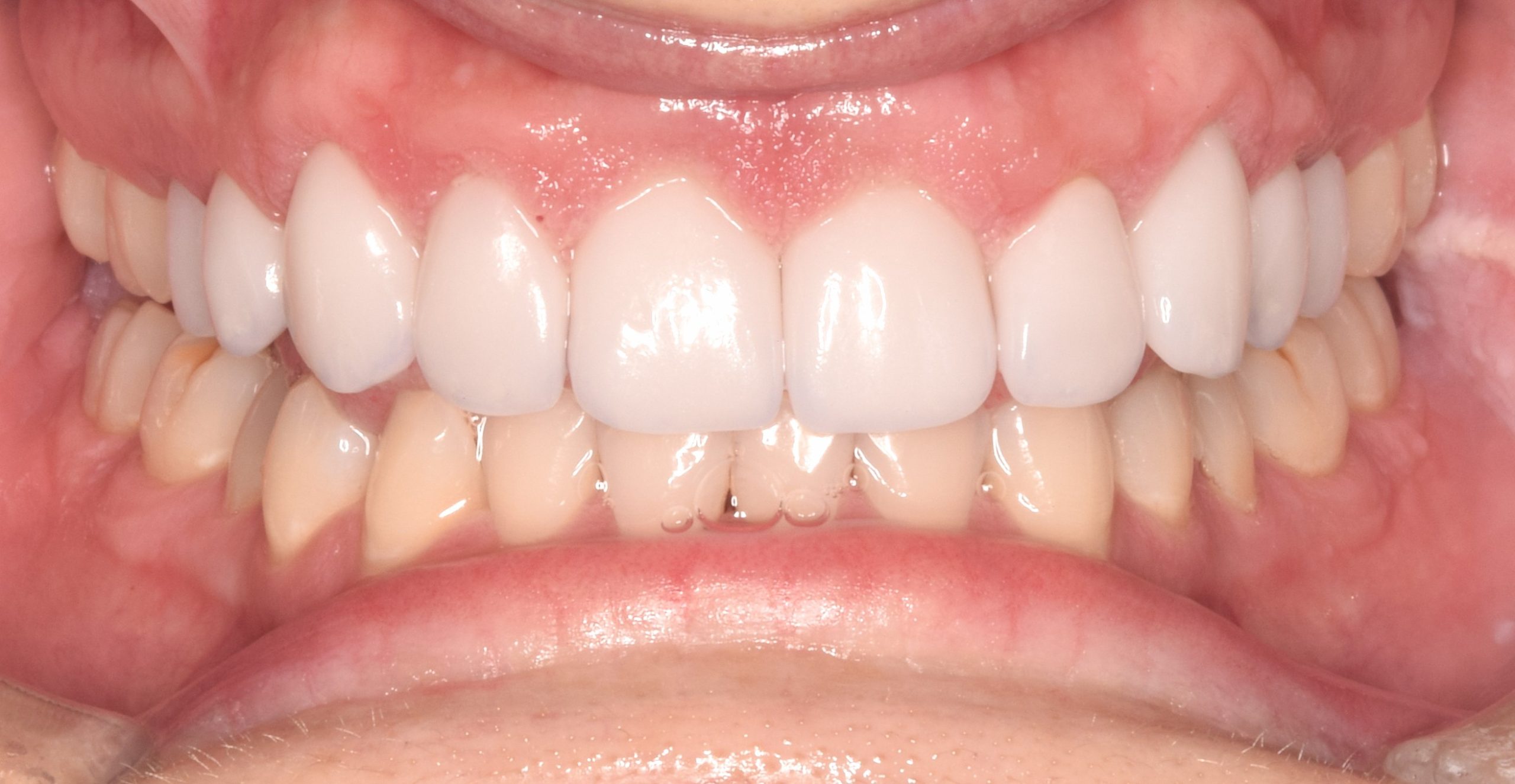 After treatment