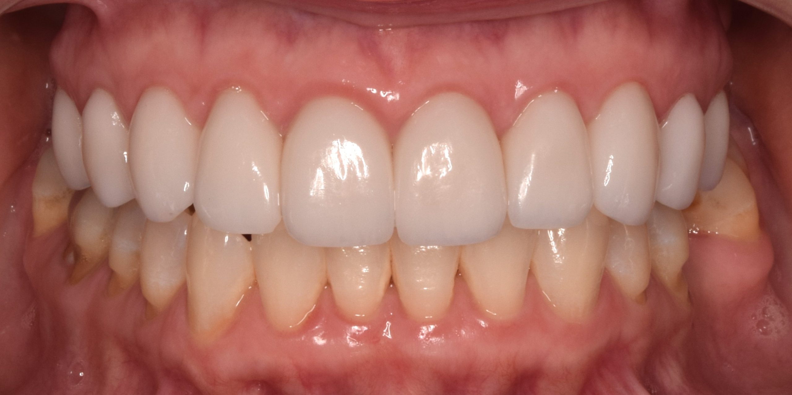 After treatment