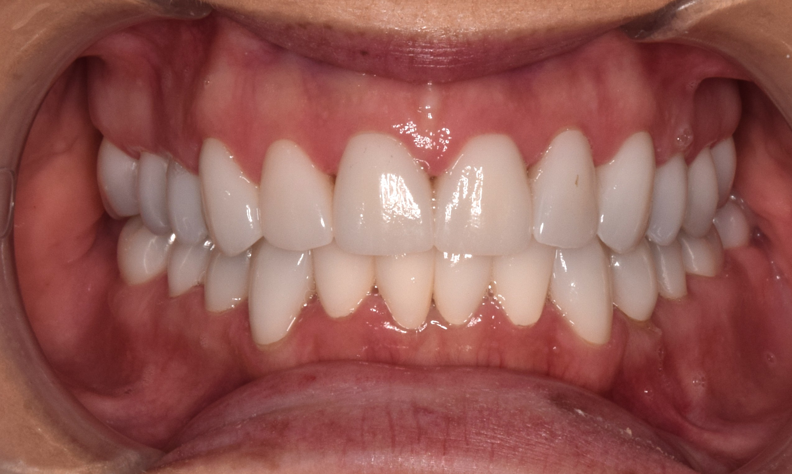After treatment