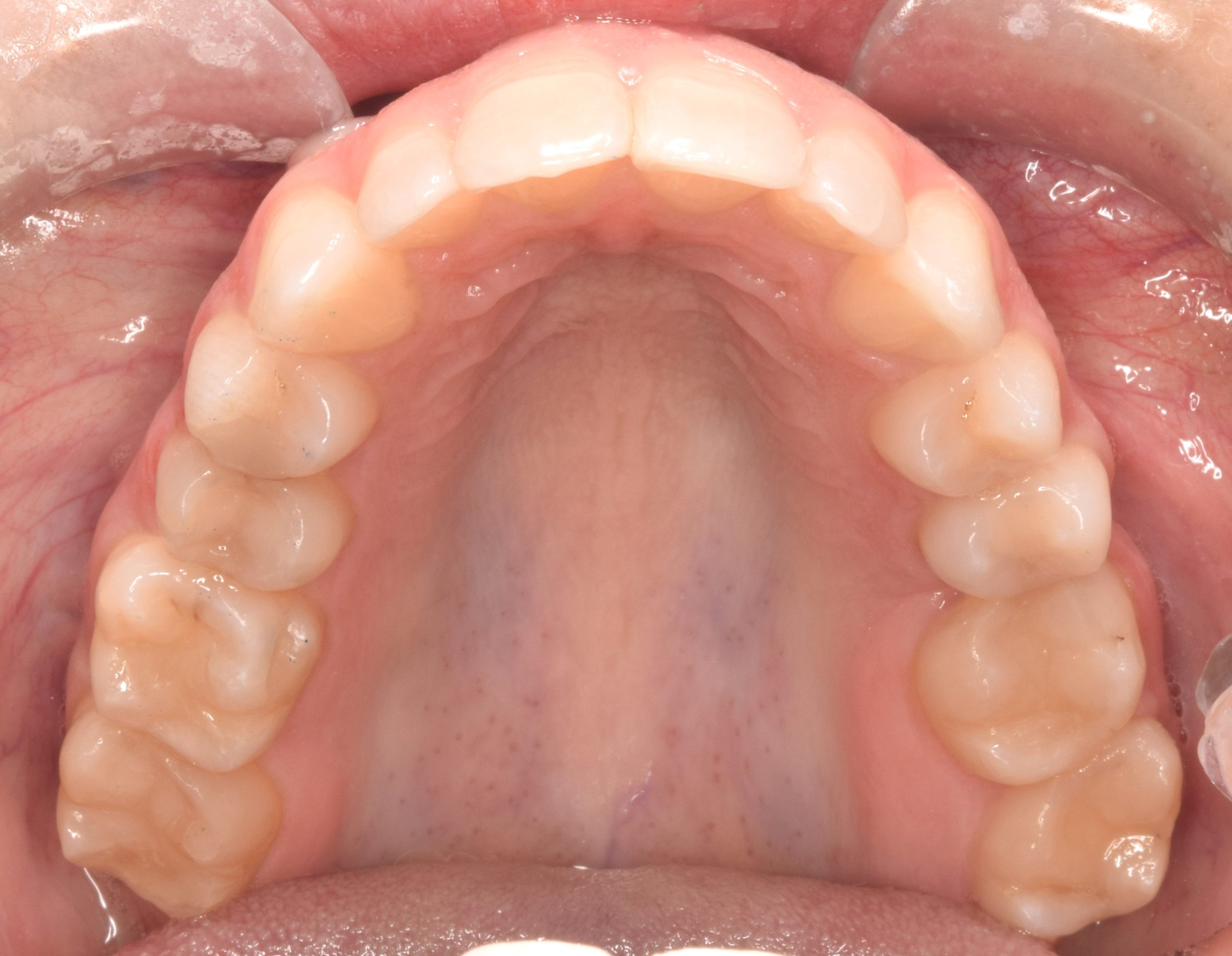 After treatment