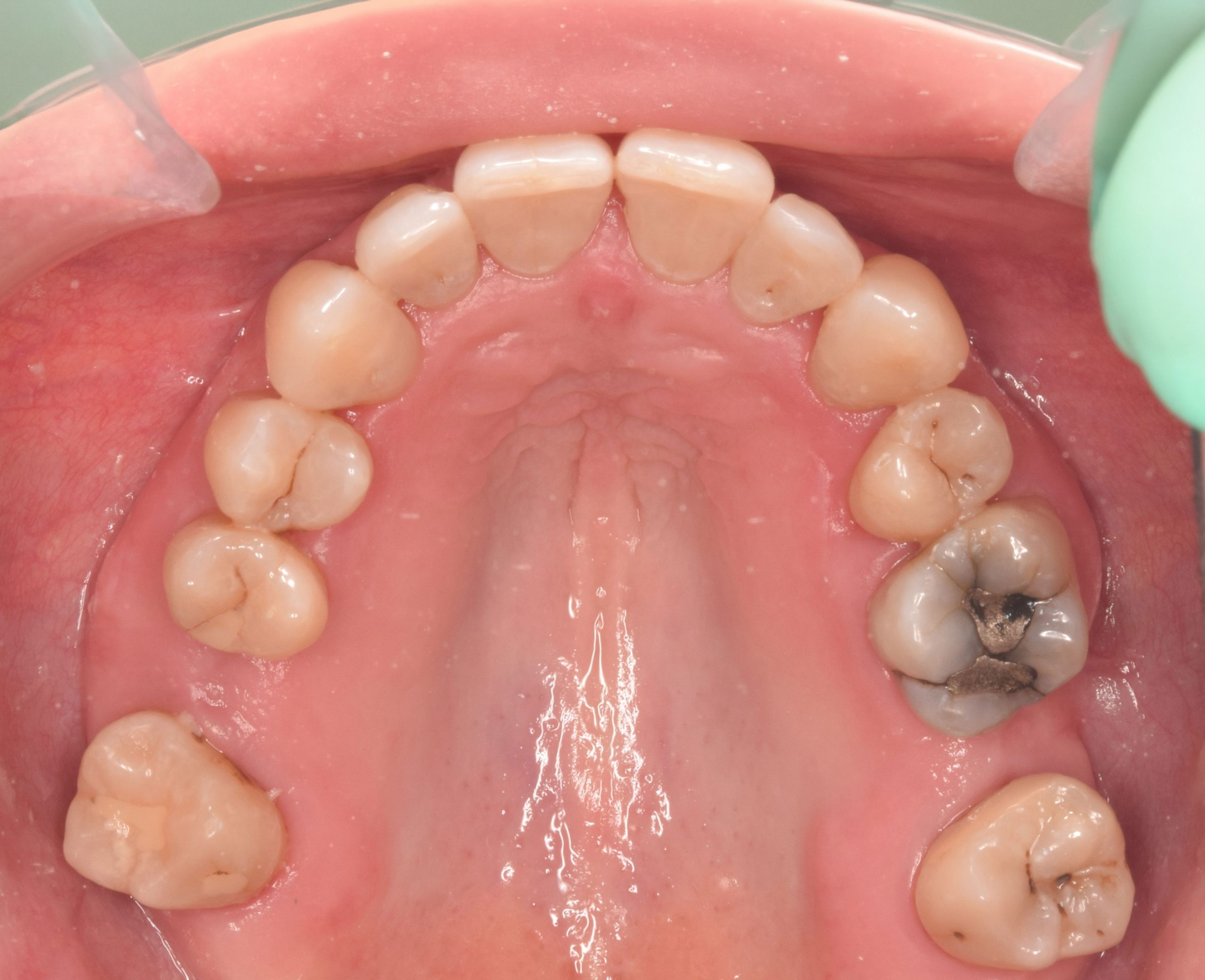 After treatment