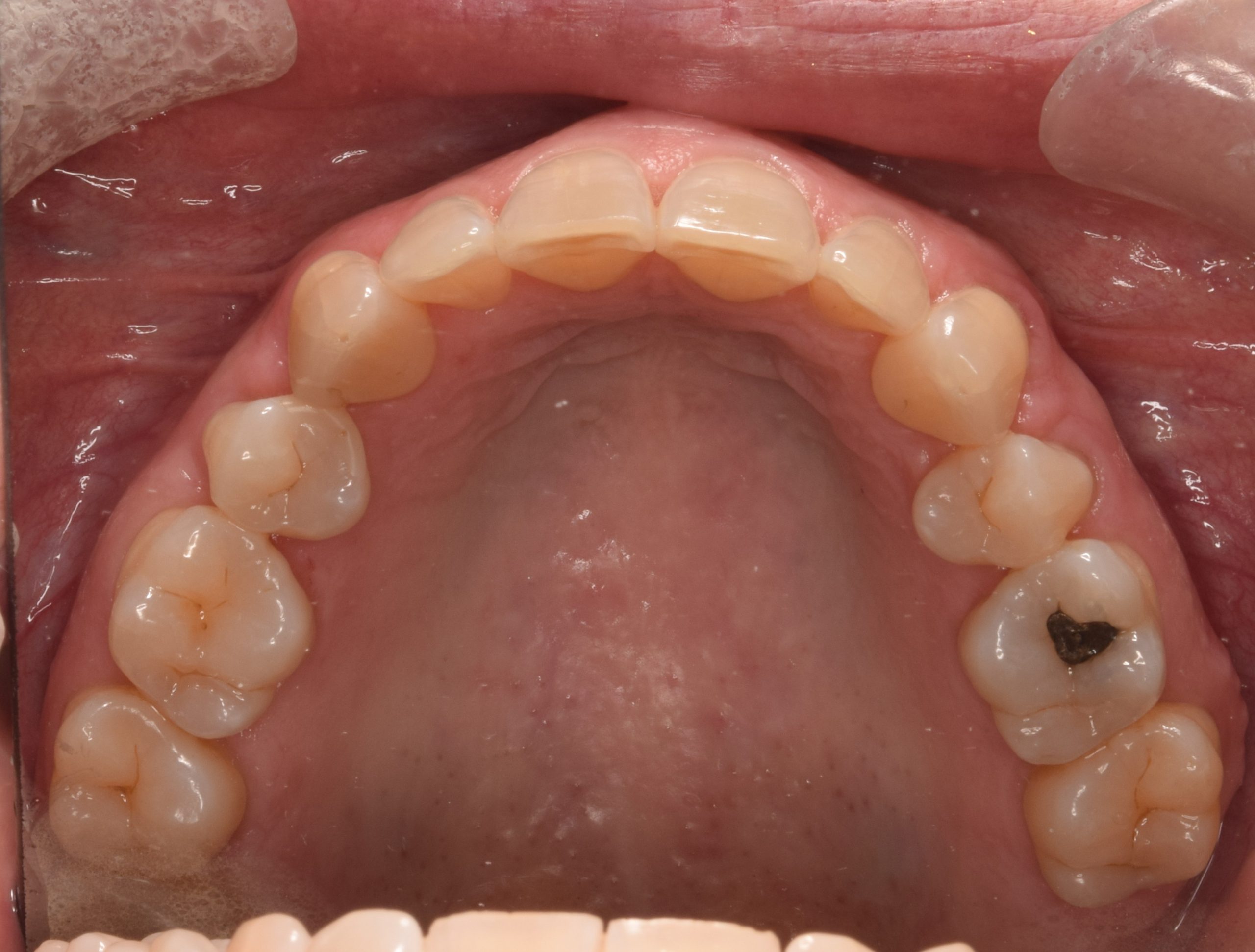 After treatment