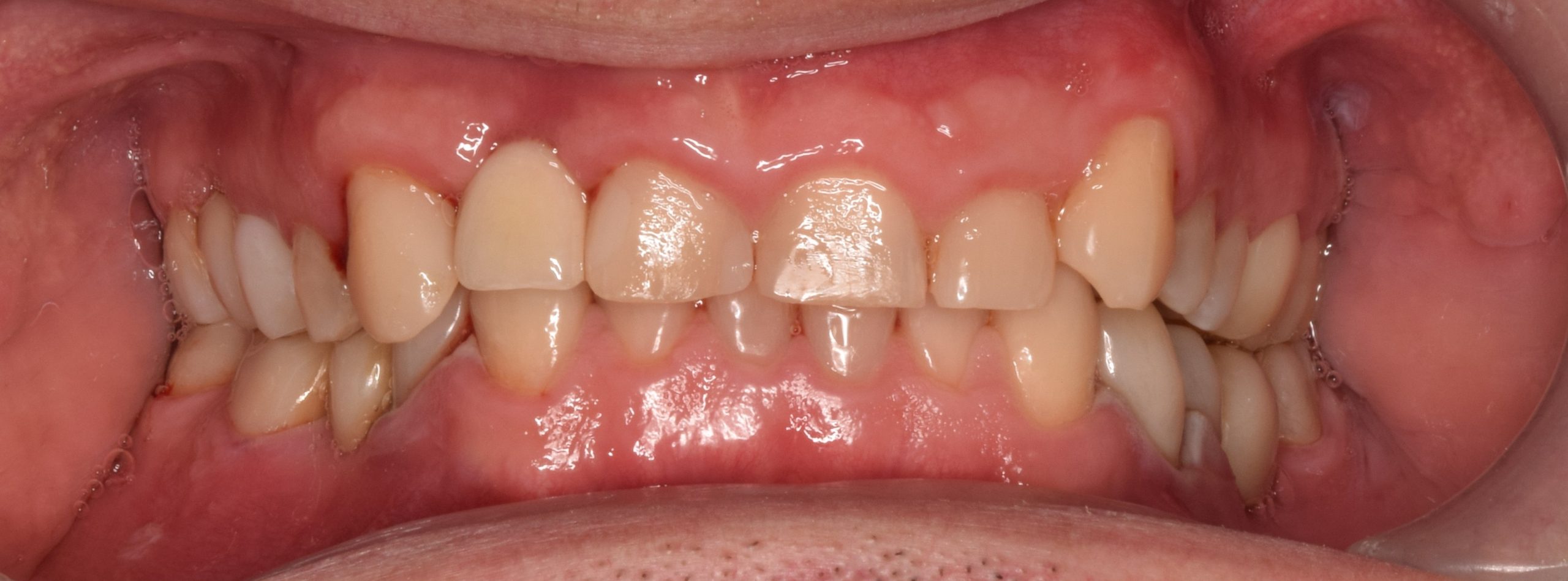 After treatment