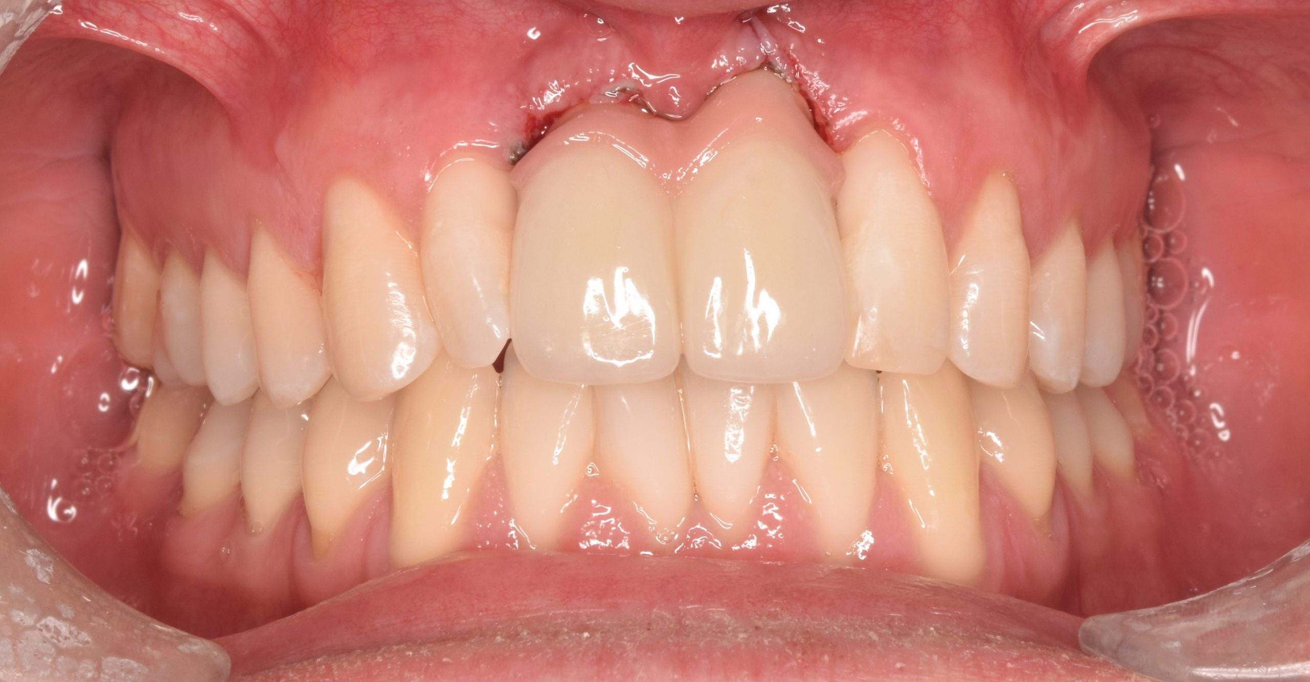 After treatment