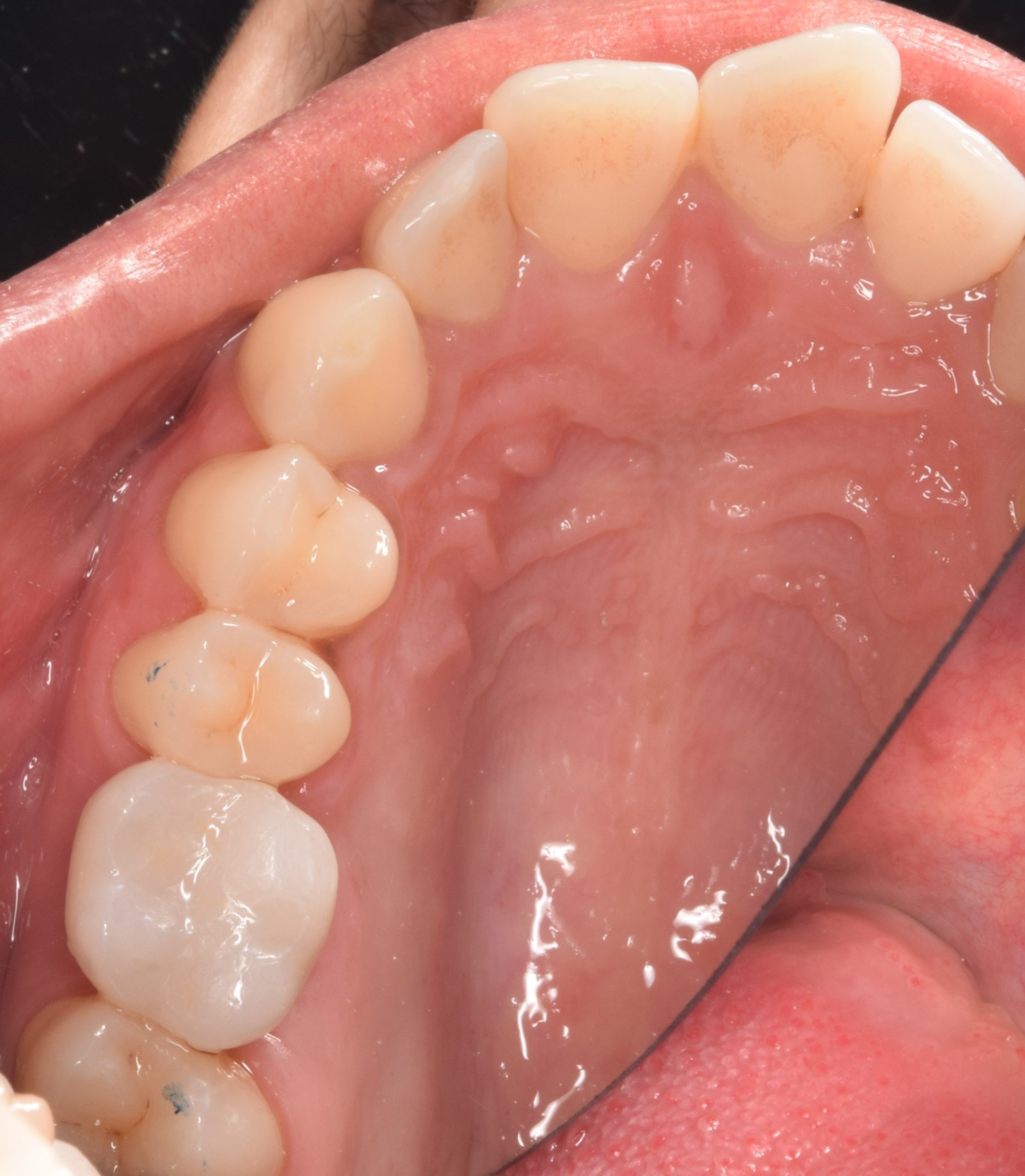 After treatment