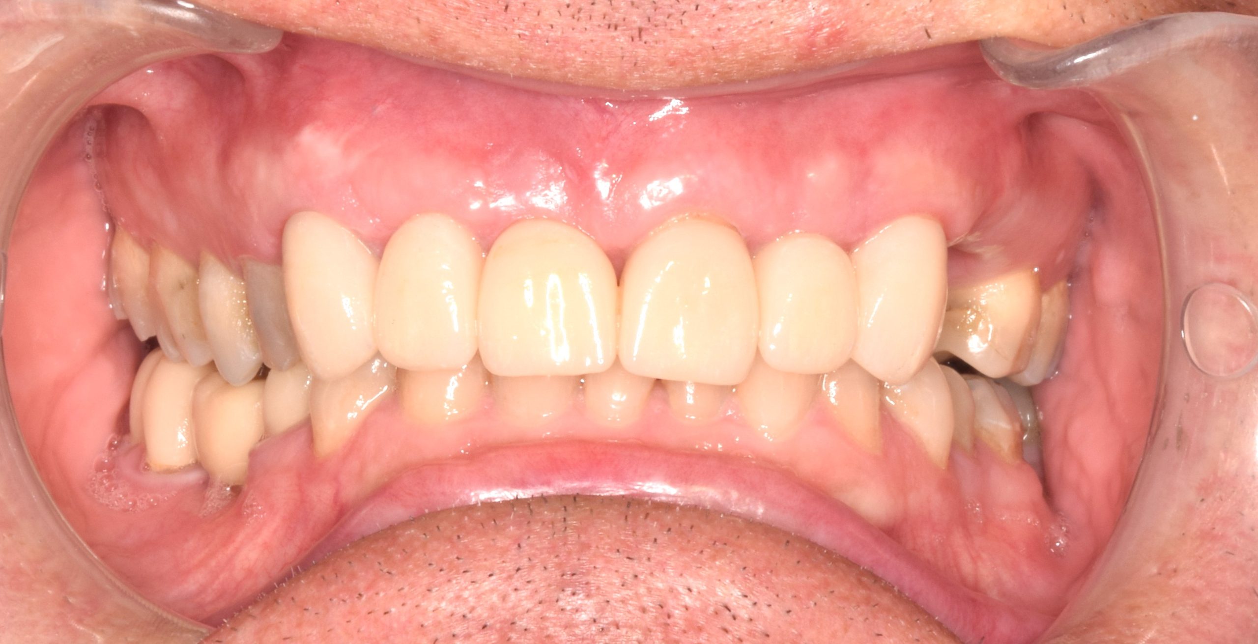 After treatment