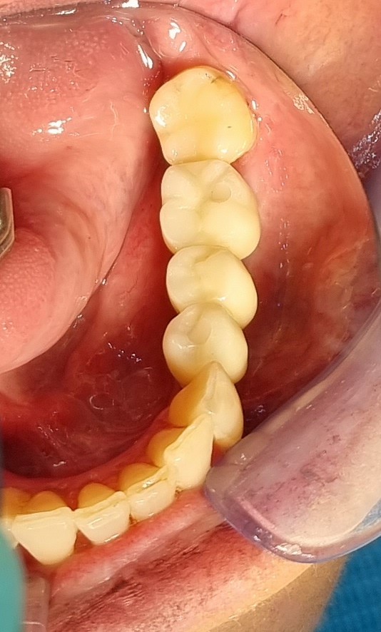 After treatment