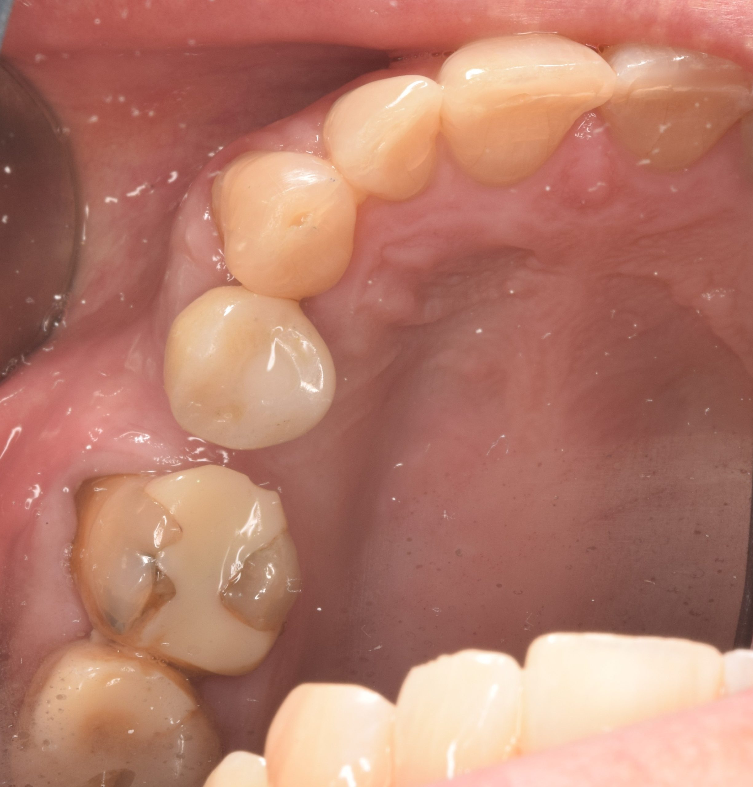 After treatment