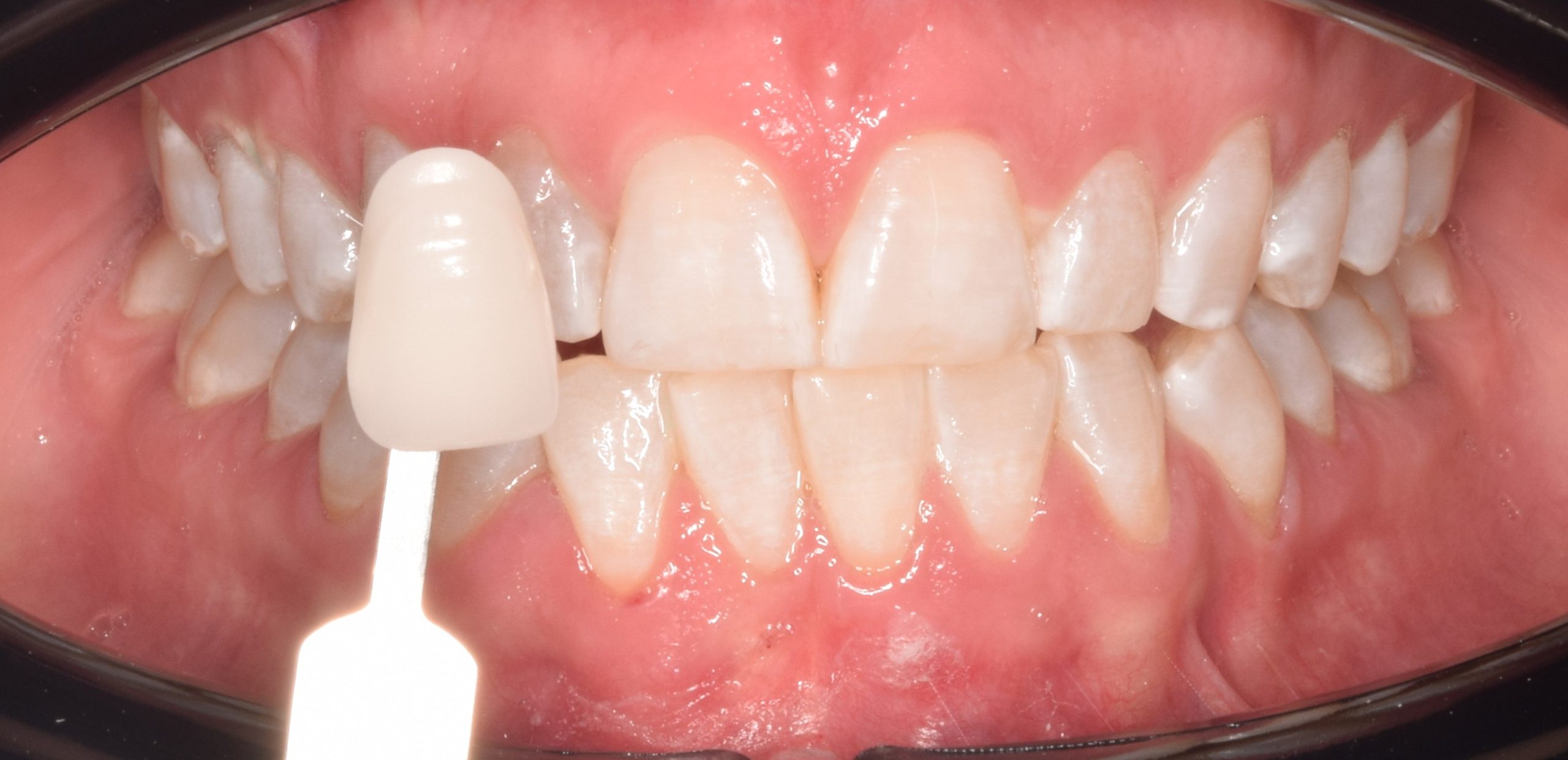 After treatment