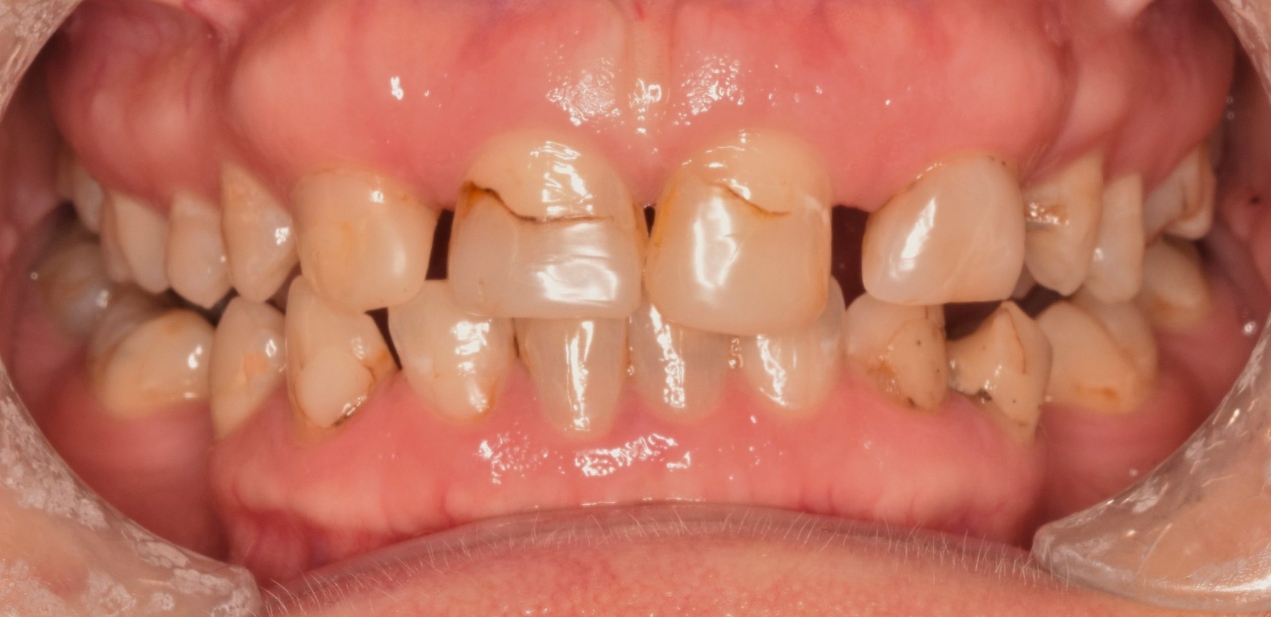 Before treatment