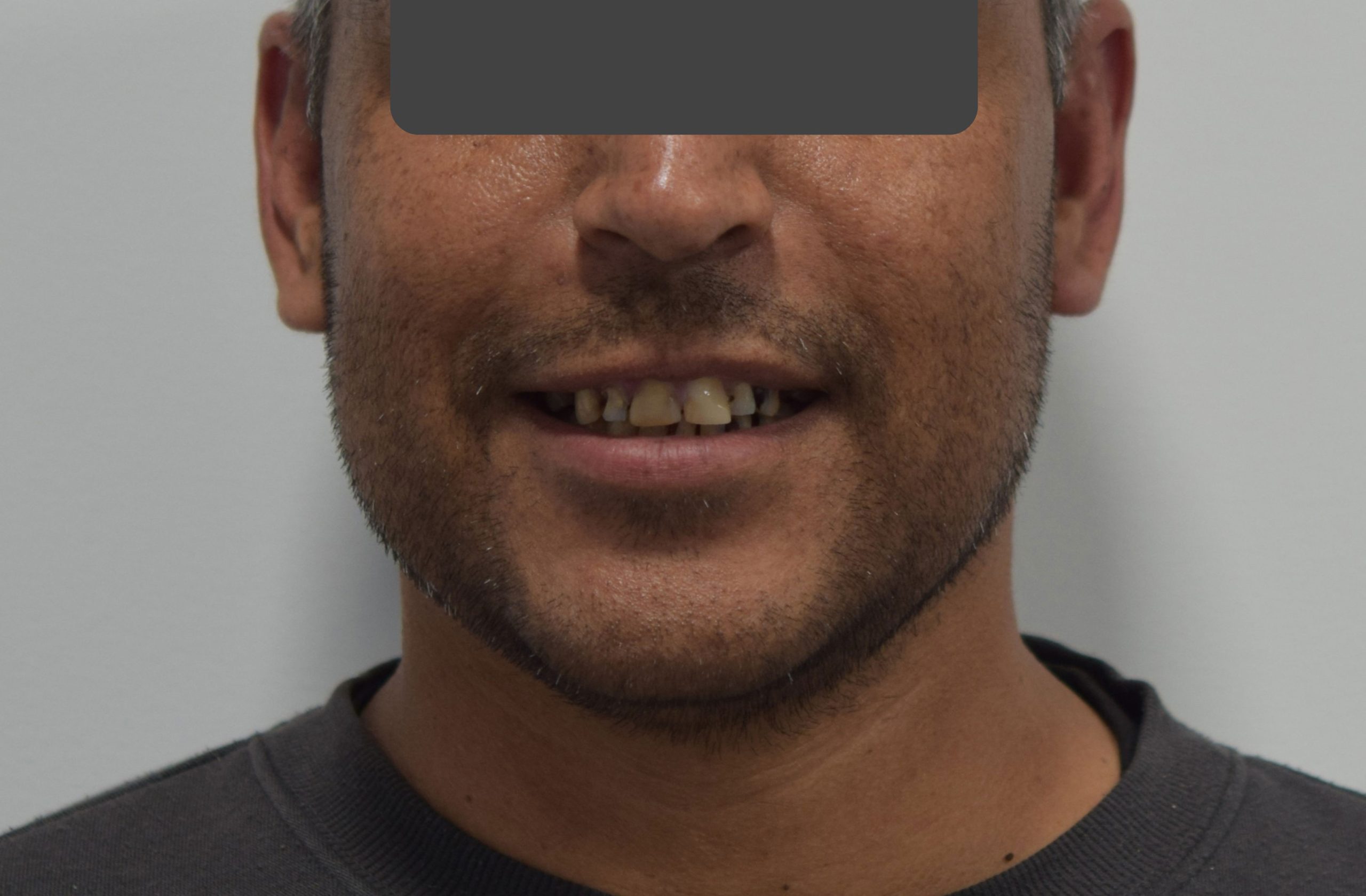 Before treatment