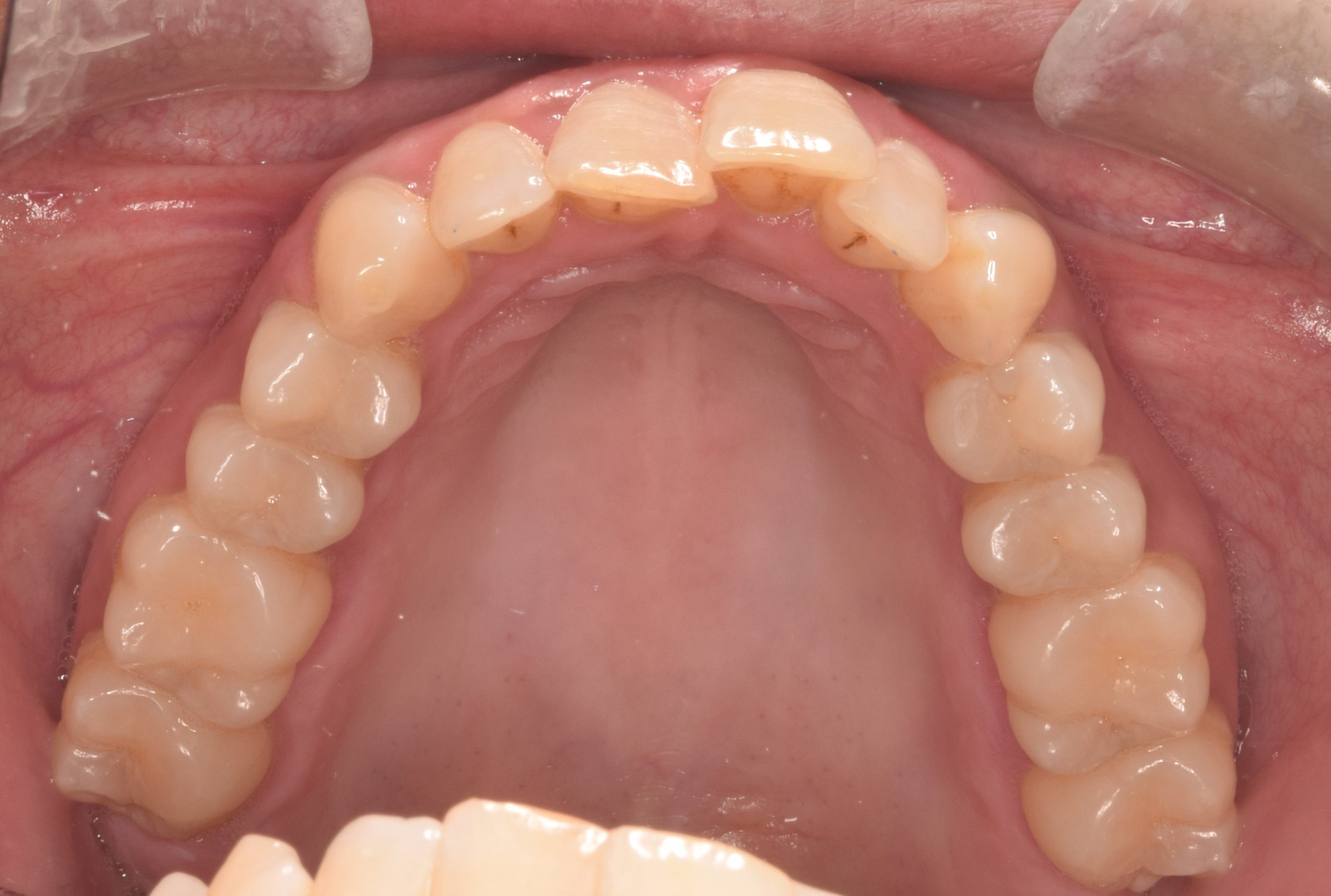 After treatment