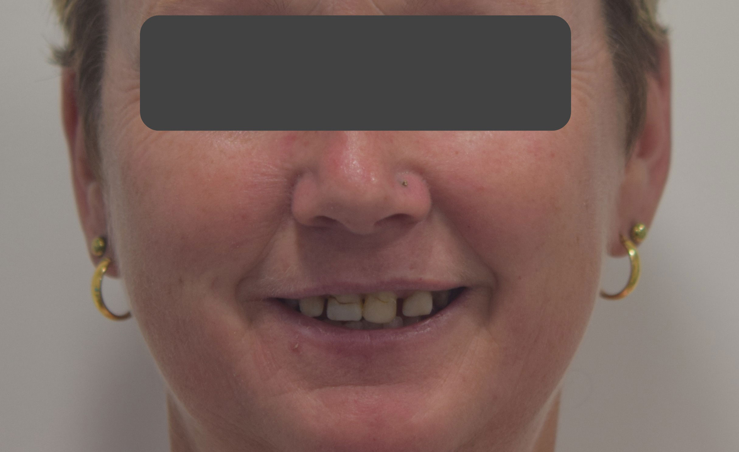 Before treatment
