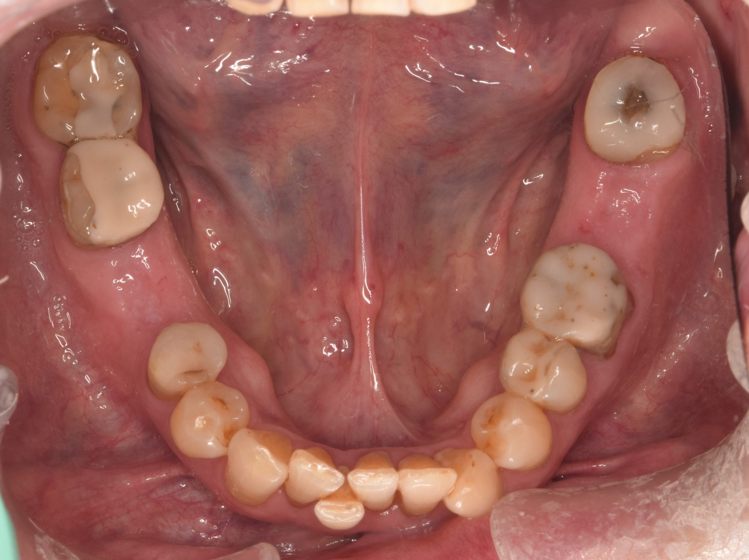 Before treatment