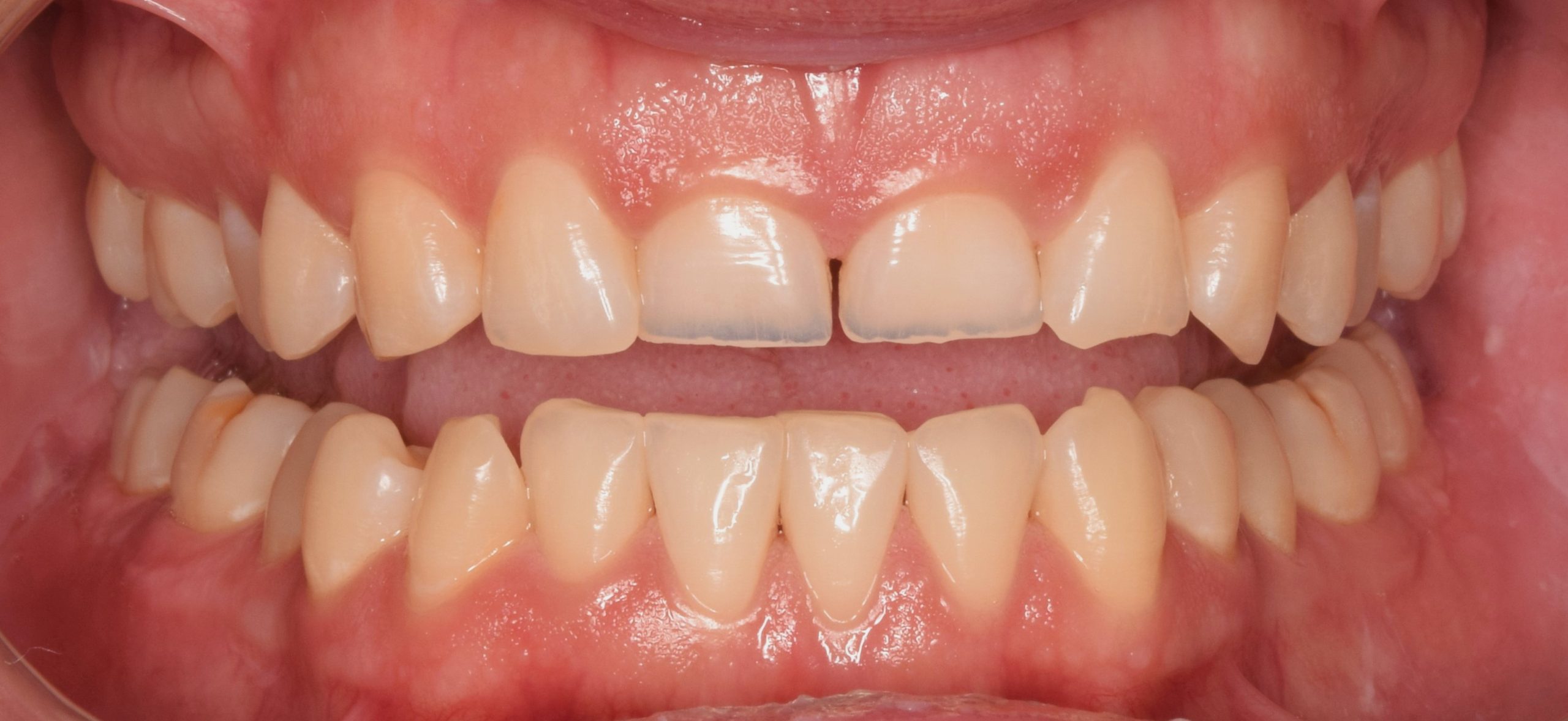Before treatment
