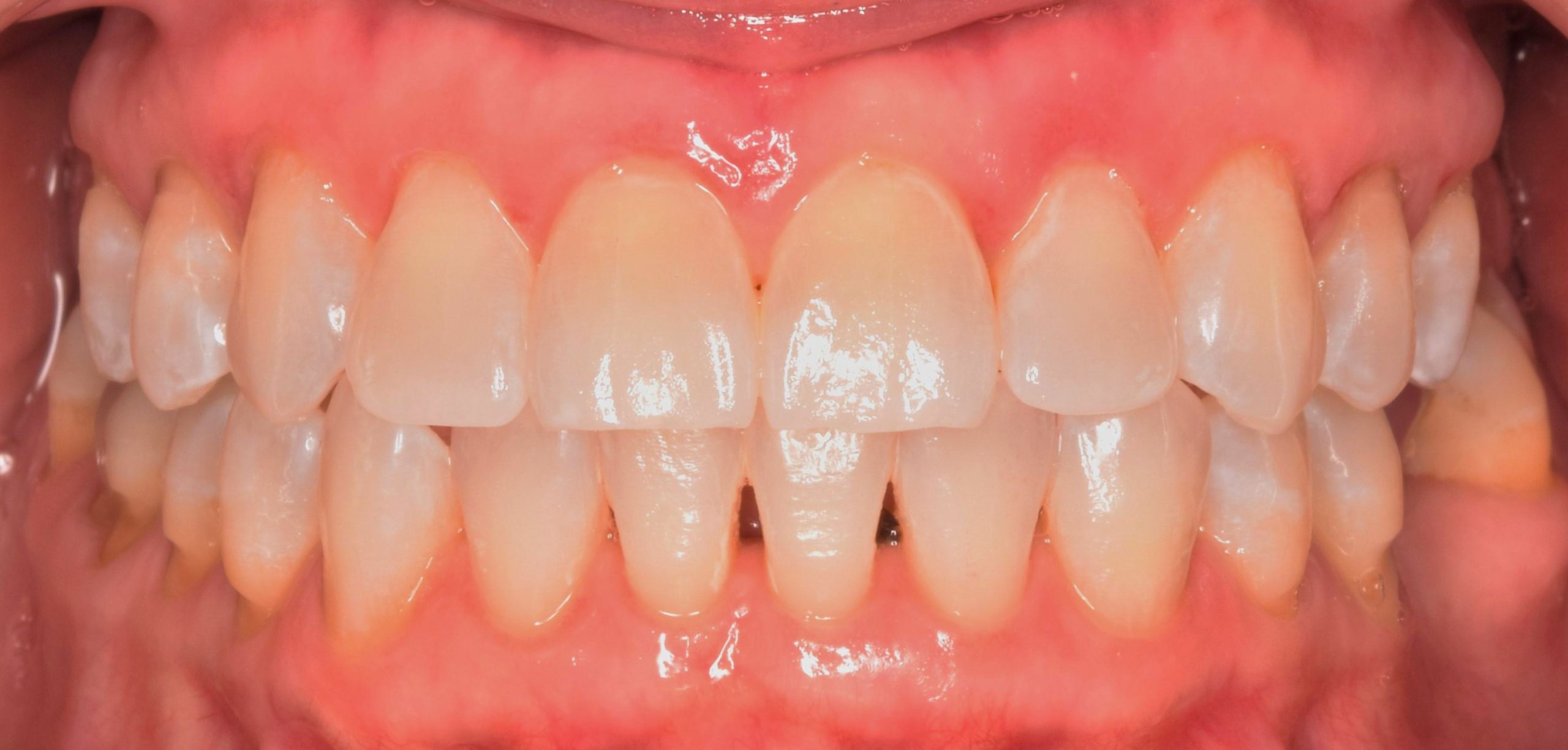 Before treatment