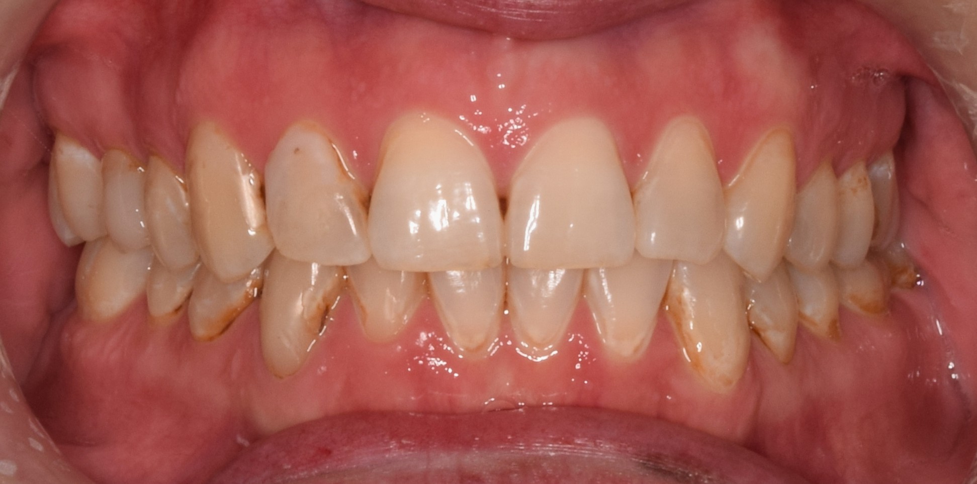 Before treatment