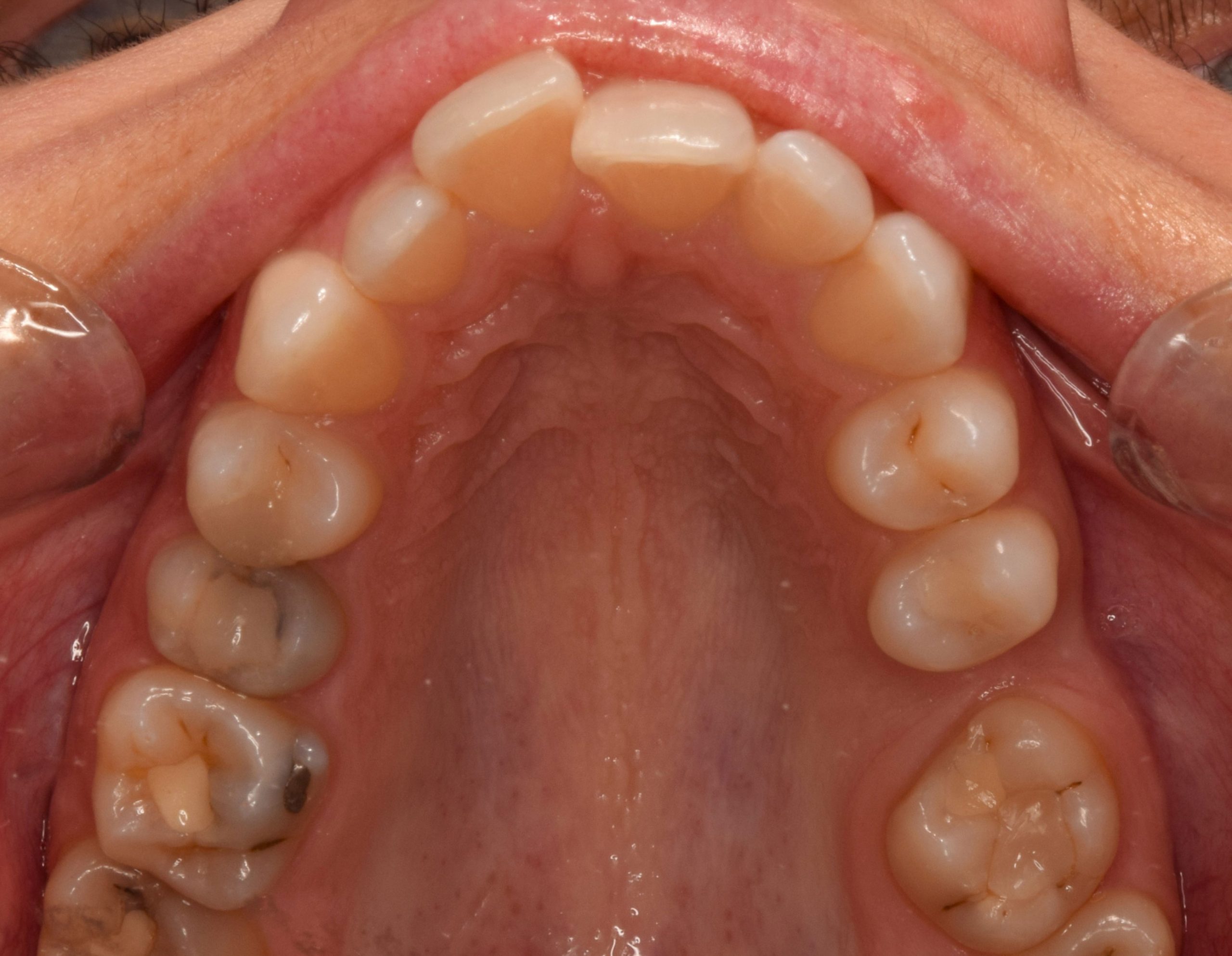 Before treatment