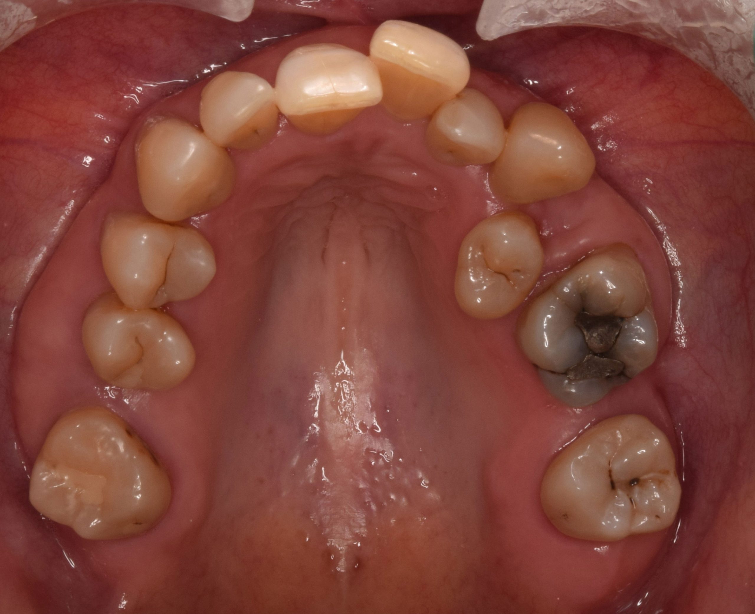 Before treatment