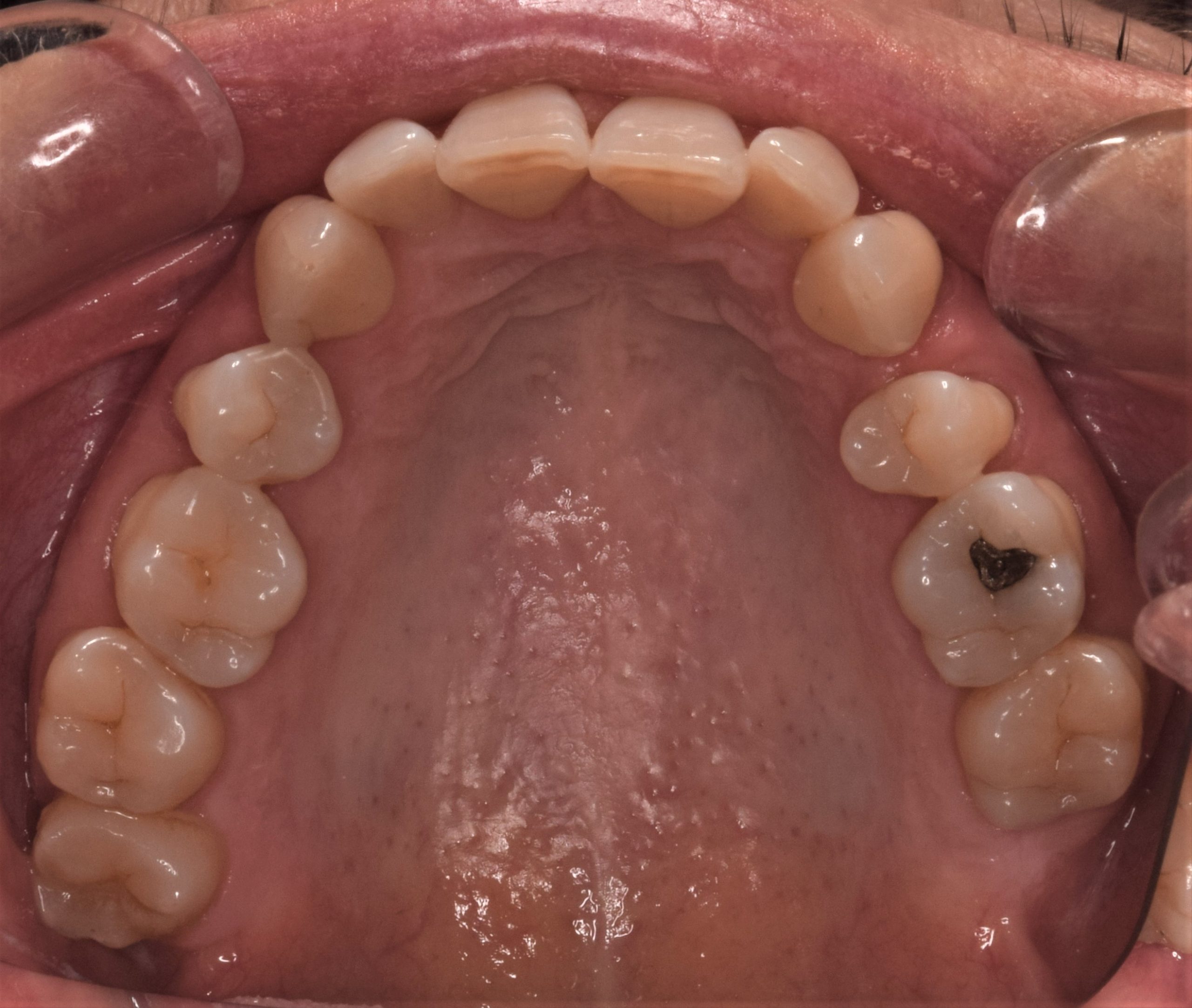 Before treatment