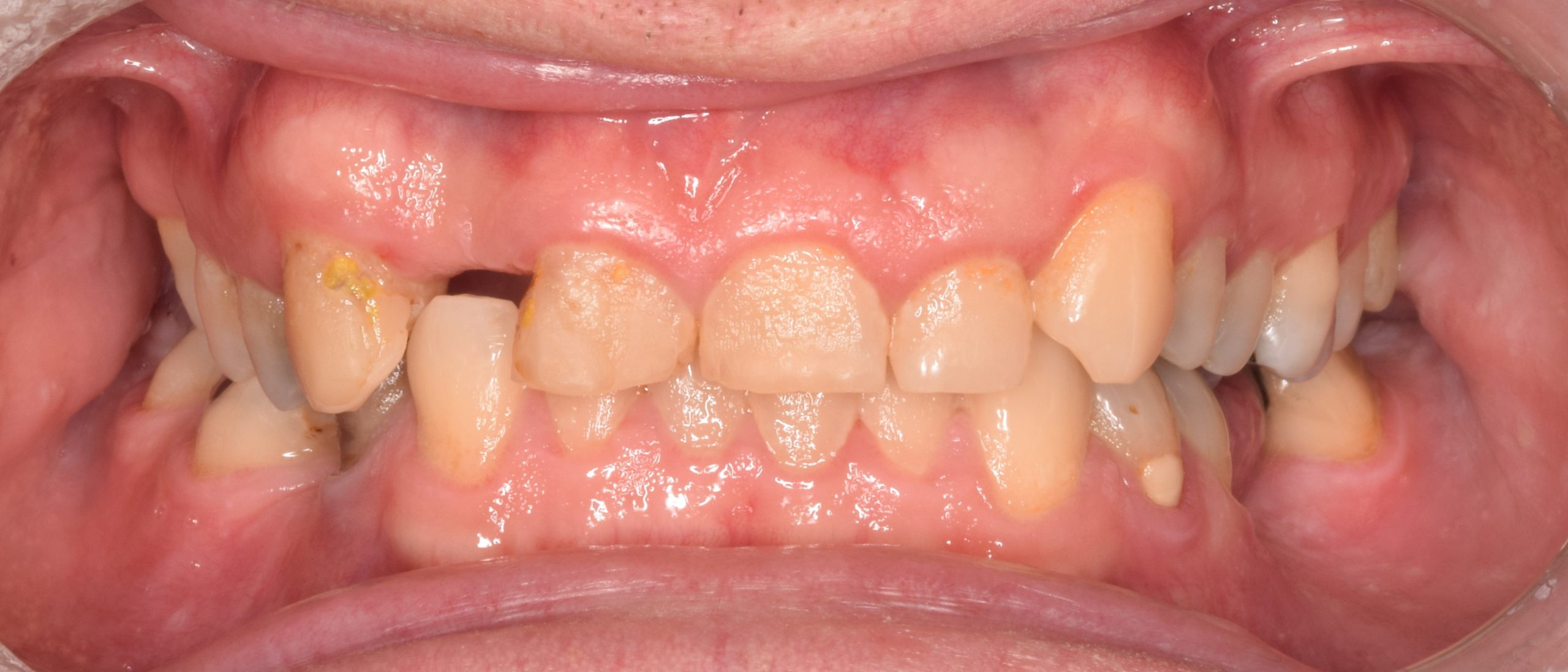 Before treatment