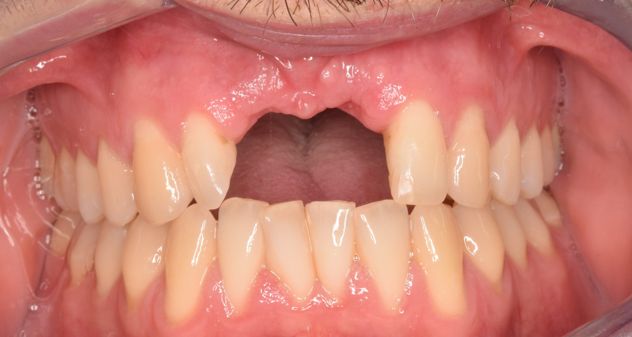 Before treatment