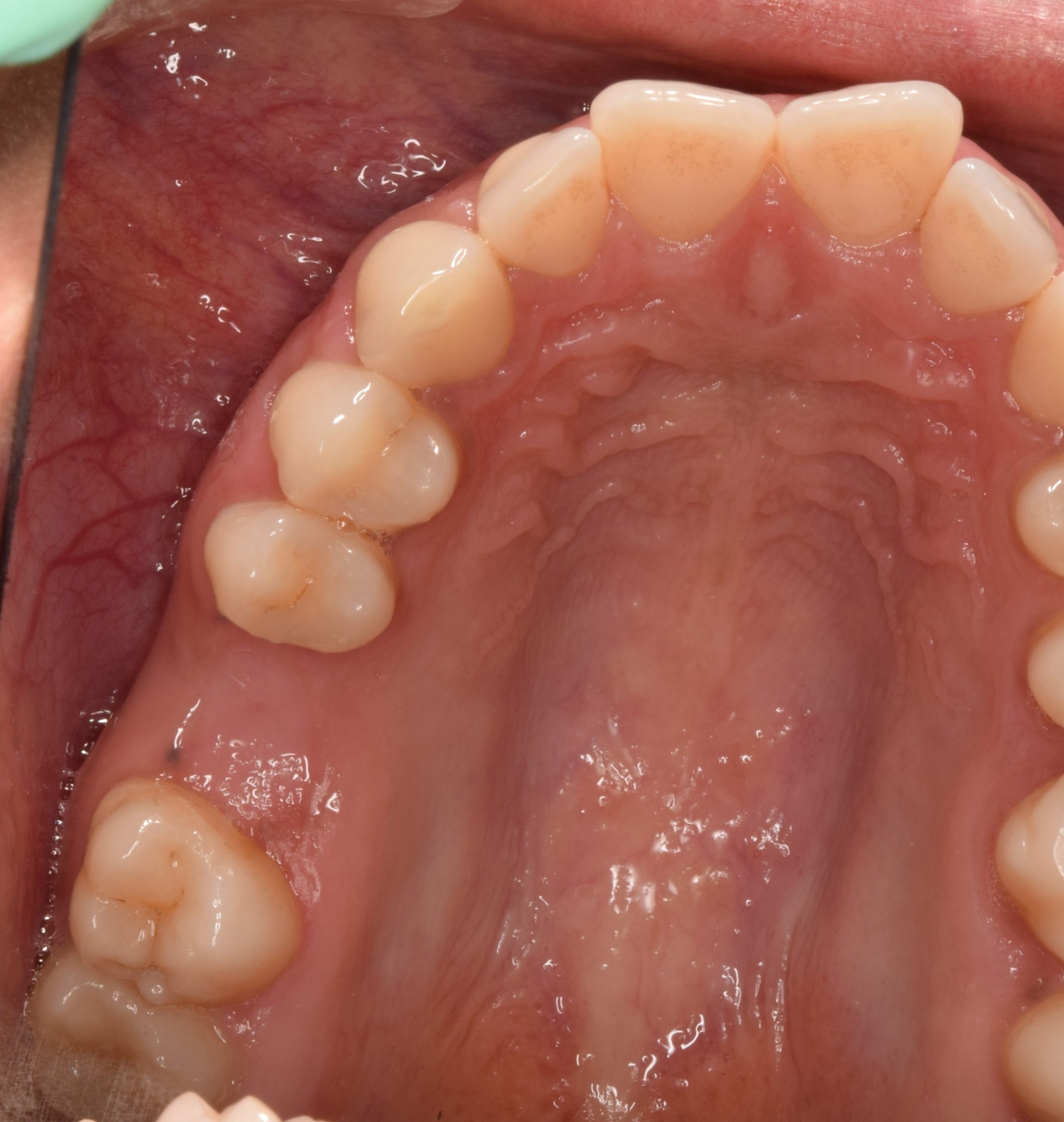 Before treatment