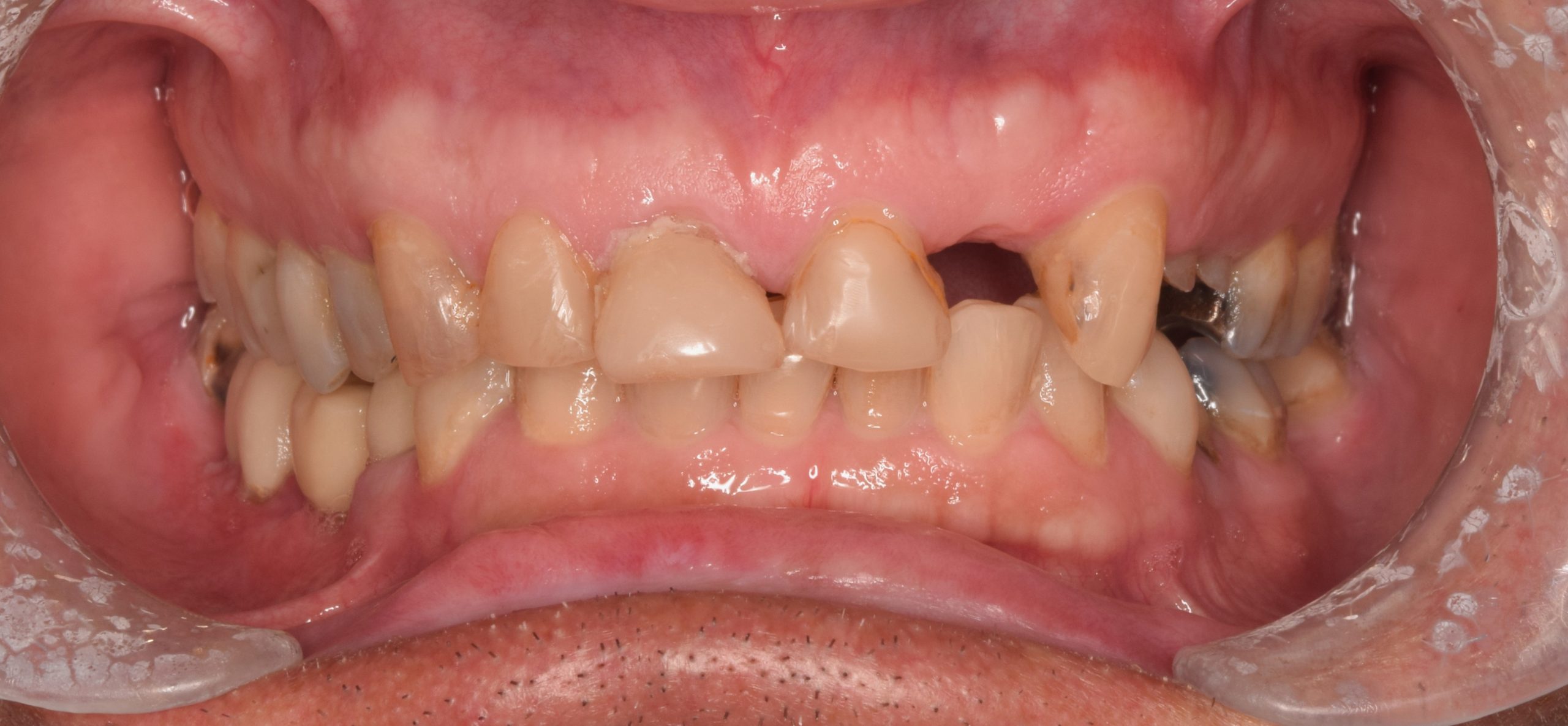 Before treatment
