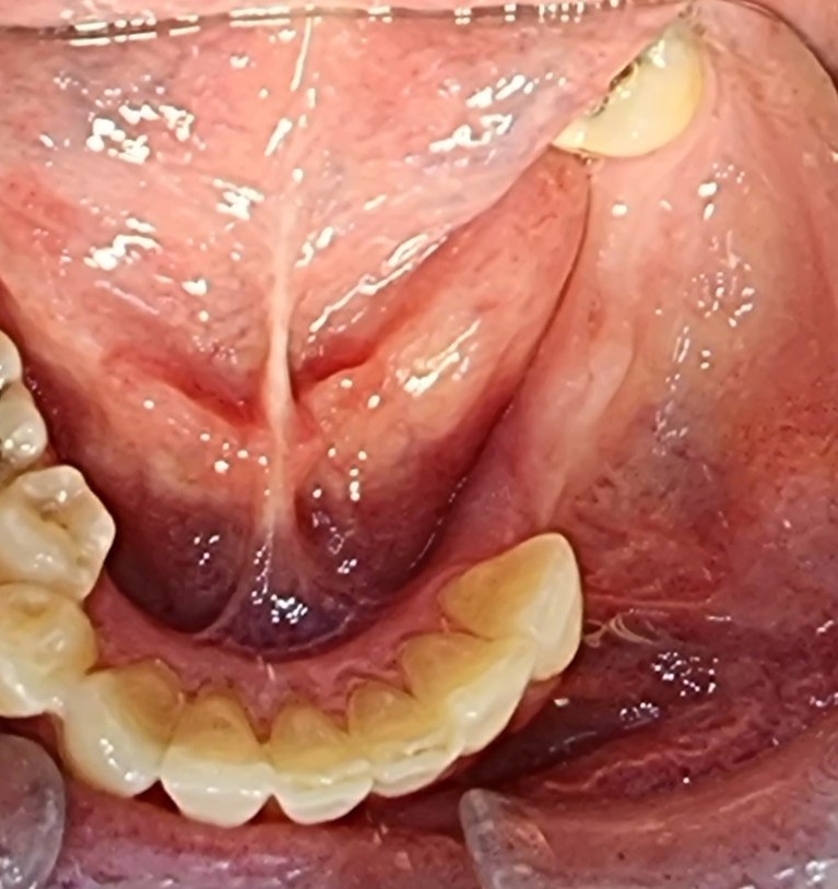 Before treatment