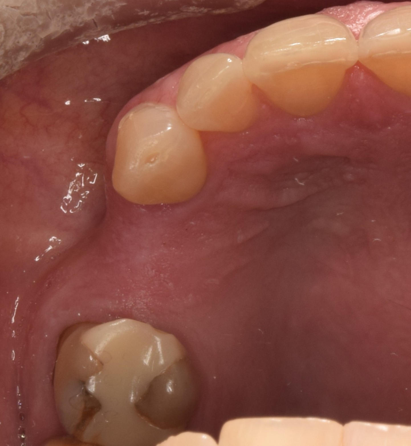 Before treatment