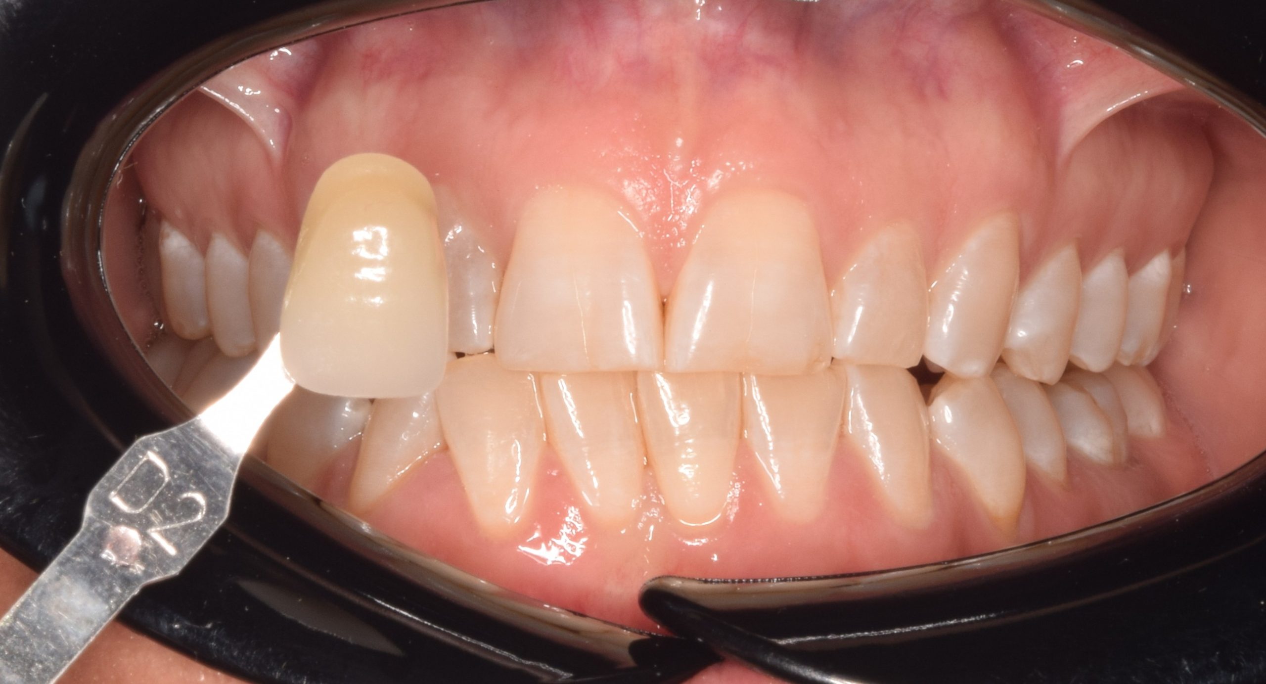 Before treatment