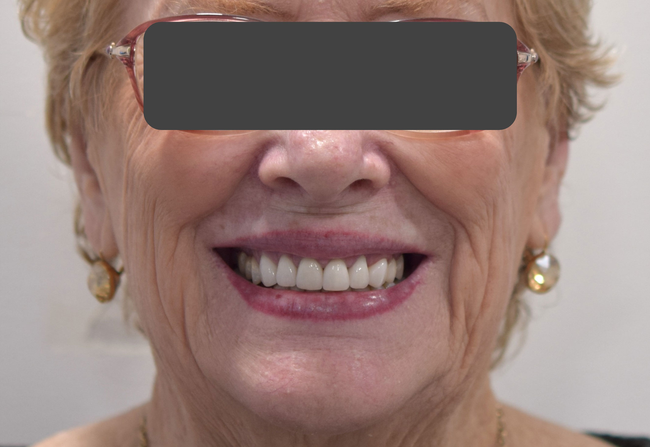 After treatment