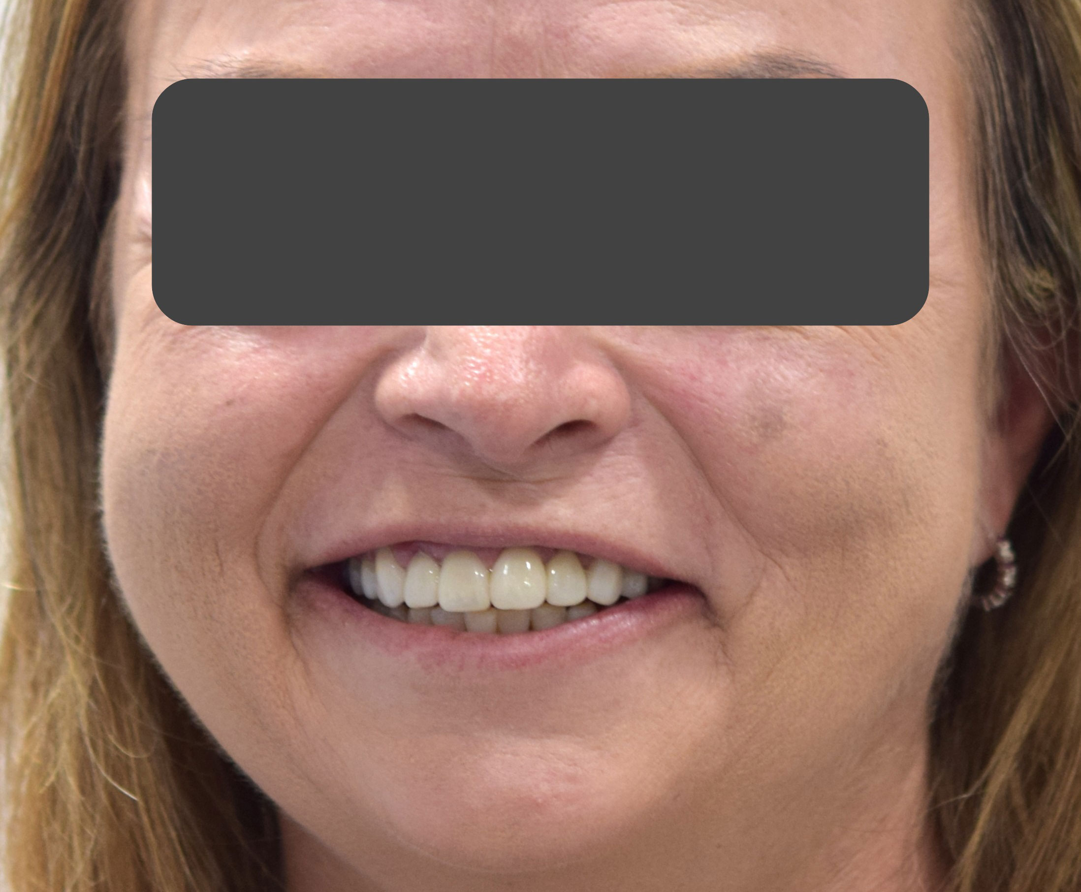 After treatment