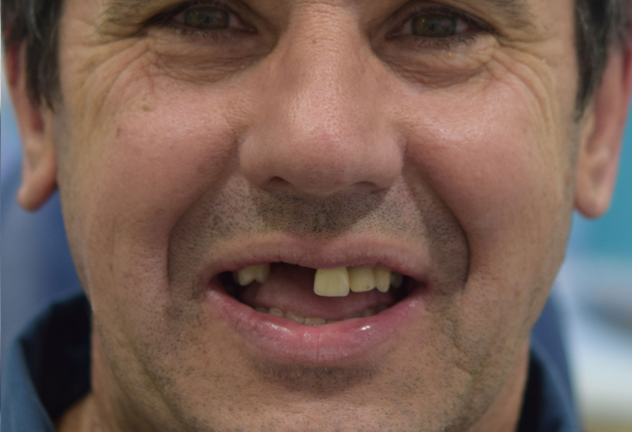 Before treatment