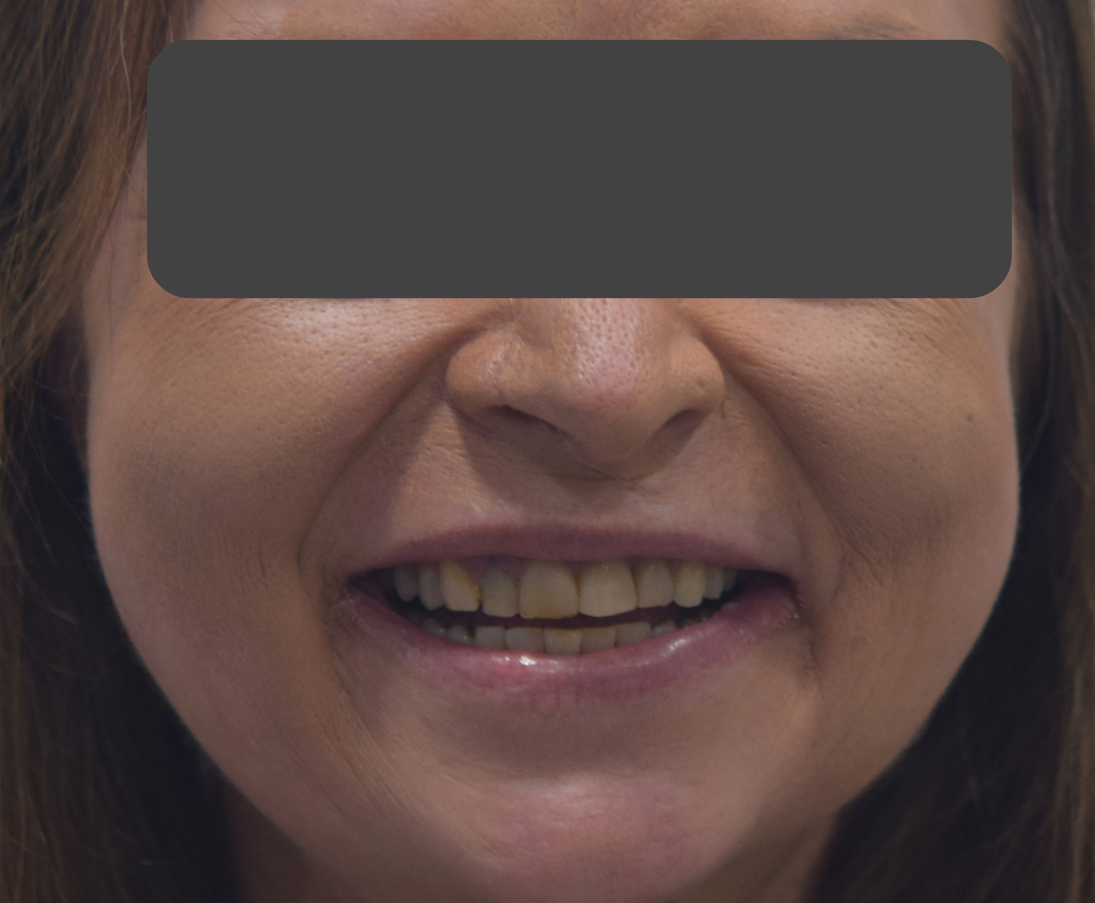 Before treatment