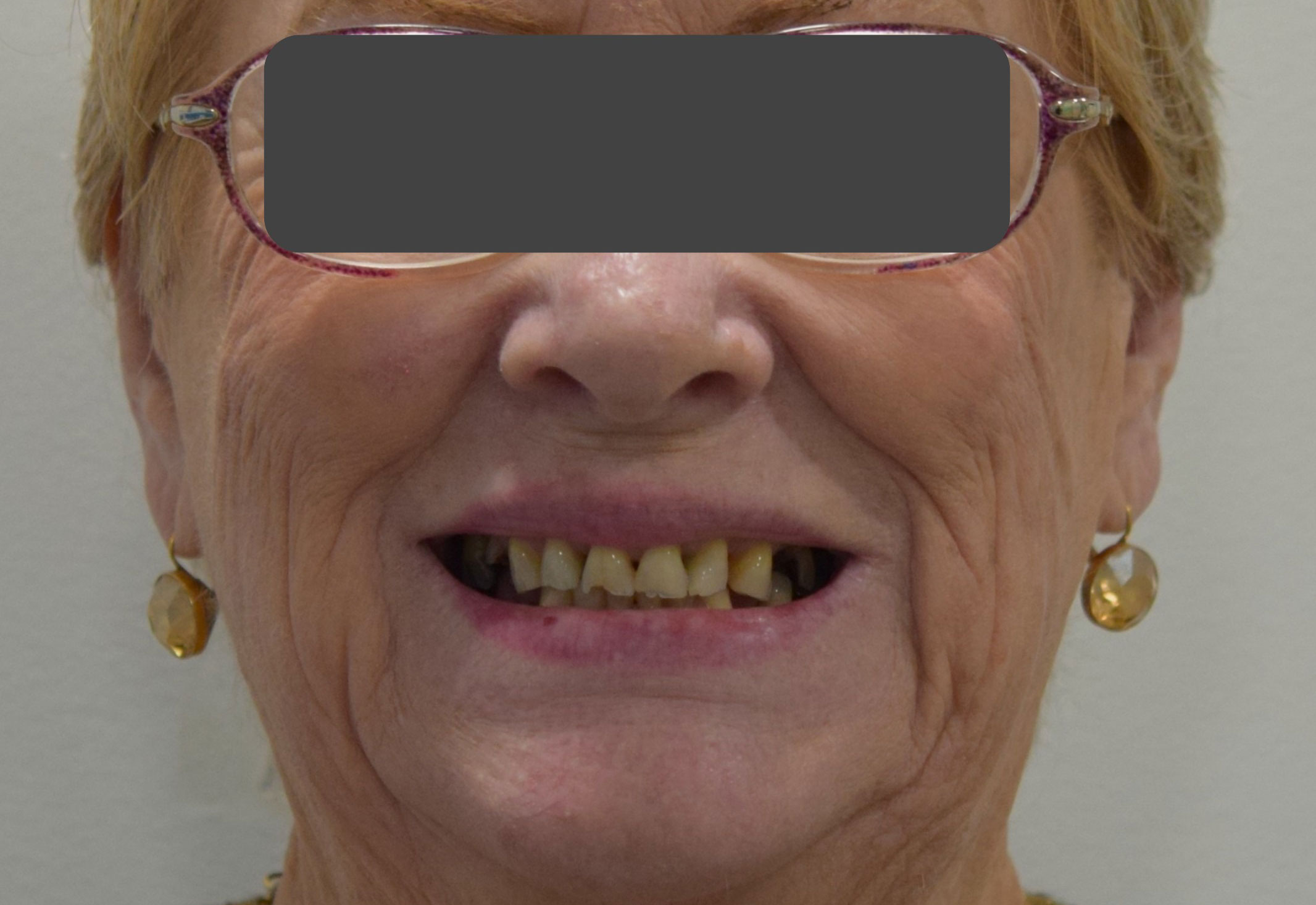 Before treatment